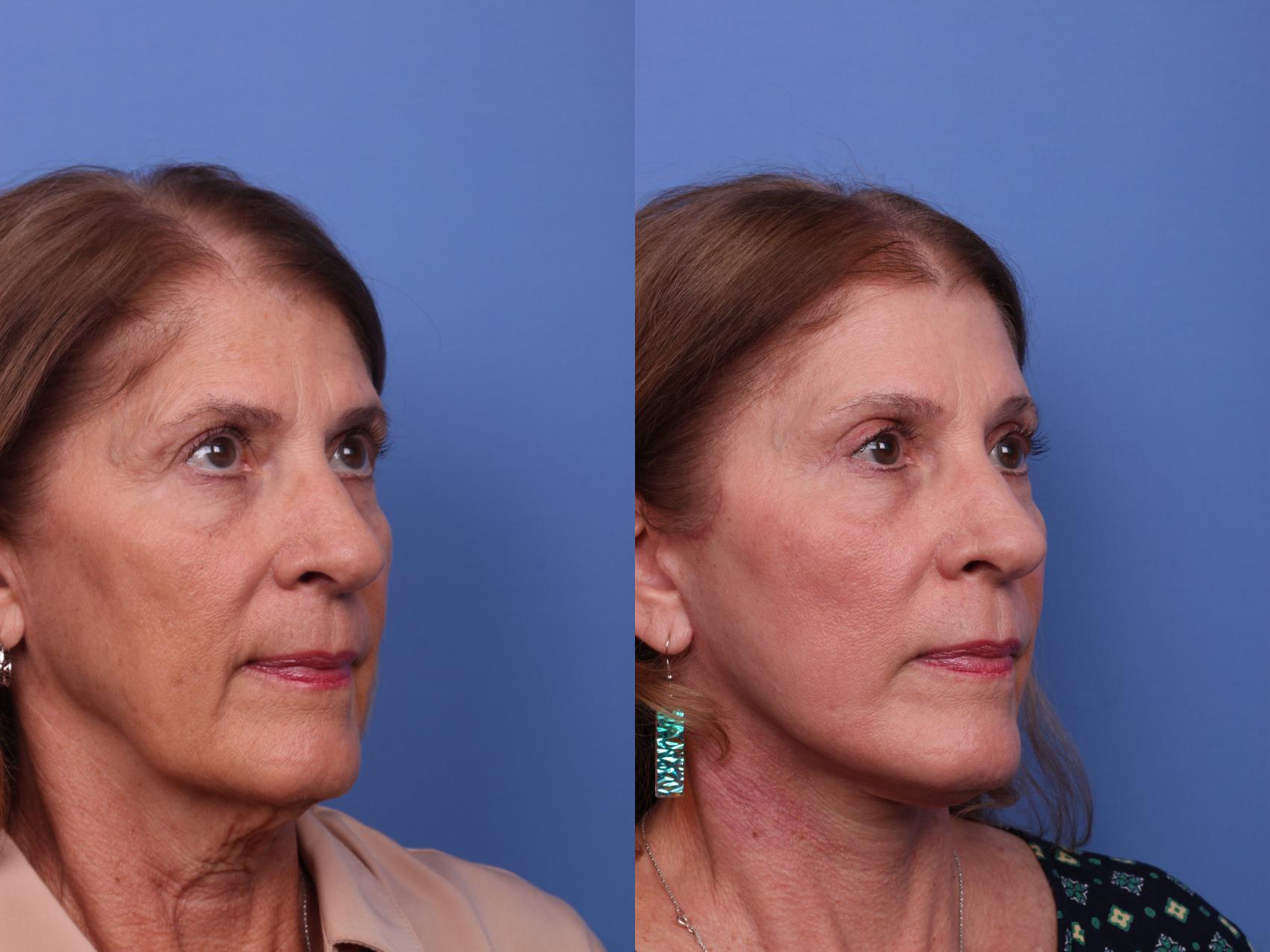 Before & After Facelift Case 522 Right Oblique View in Scottsdale, AZ
