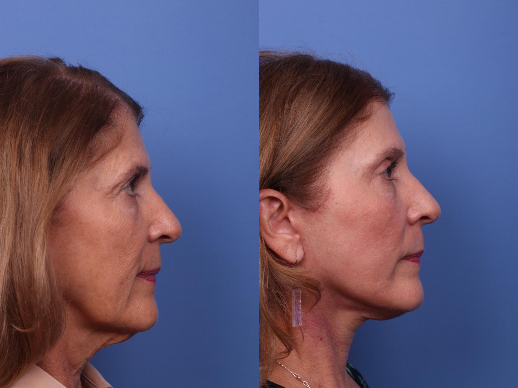 Before & After Facelift Case 522 Right Side View in Scottsdale, AZ