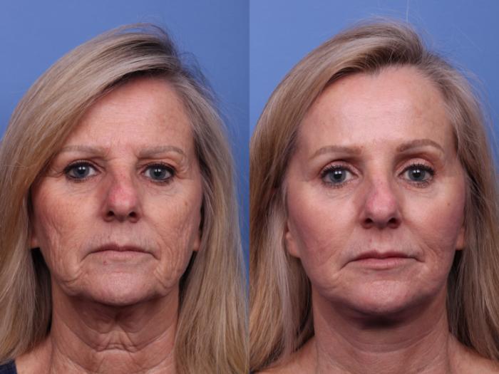 Brow Lift Before & After Photo | Scottsdale, AZ | Hobgood Facial Plastic Surgery: Todd Hobgood, MD
