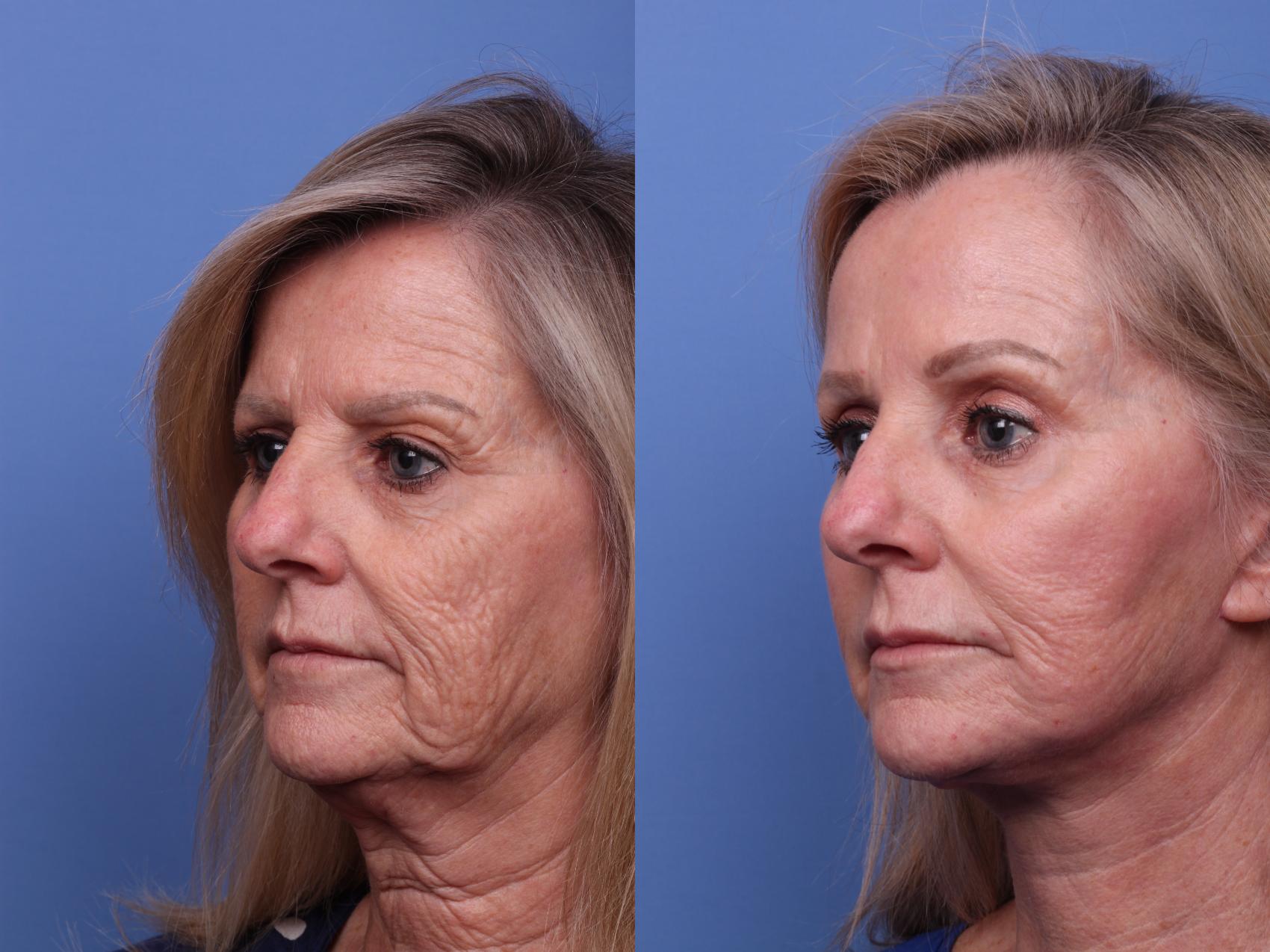 Before & After Facelift Case 529 Left Oblique View in Scottsdale, AZ
