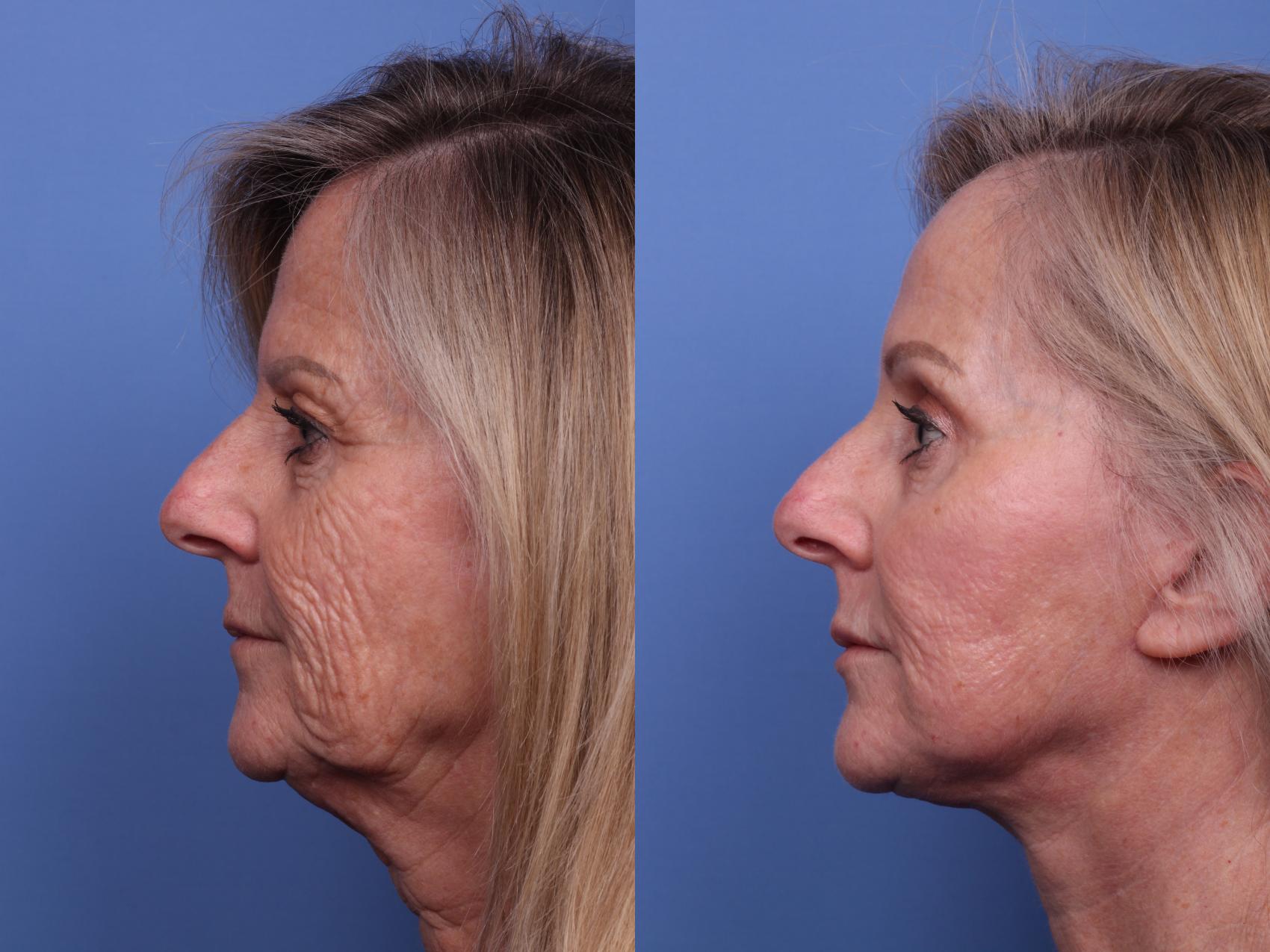 Before & After Facelift Case 529 Left Side View in Scottsdale, AZ