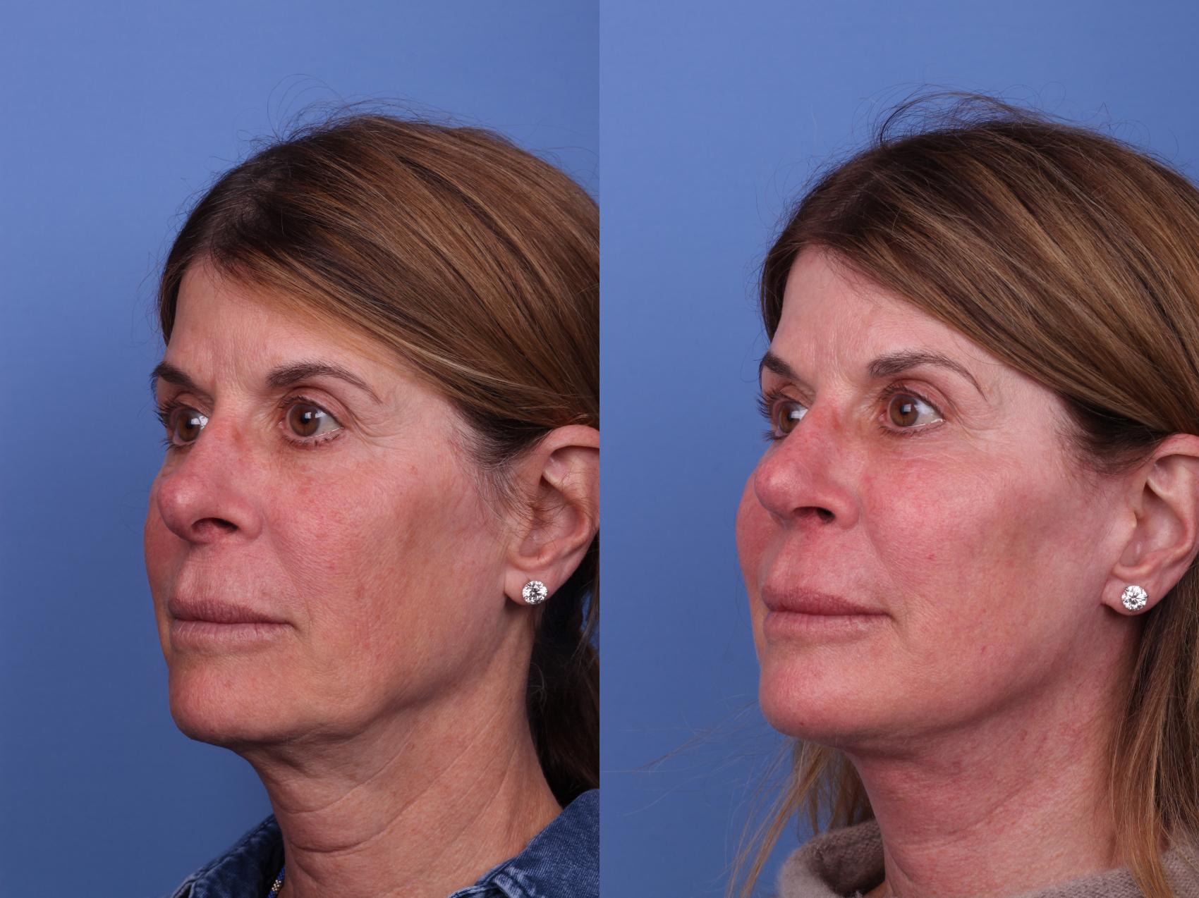 Before & After Facelift Case 537 Left Oblique View in Scottsdale, AZ