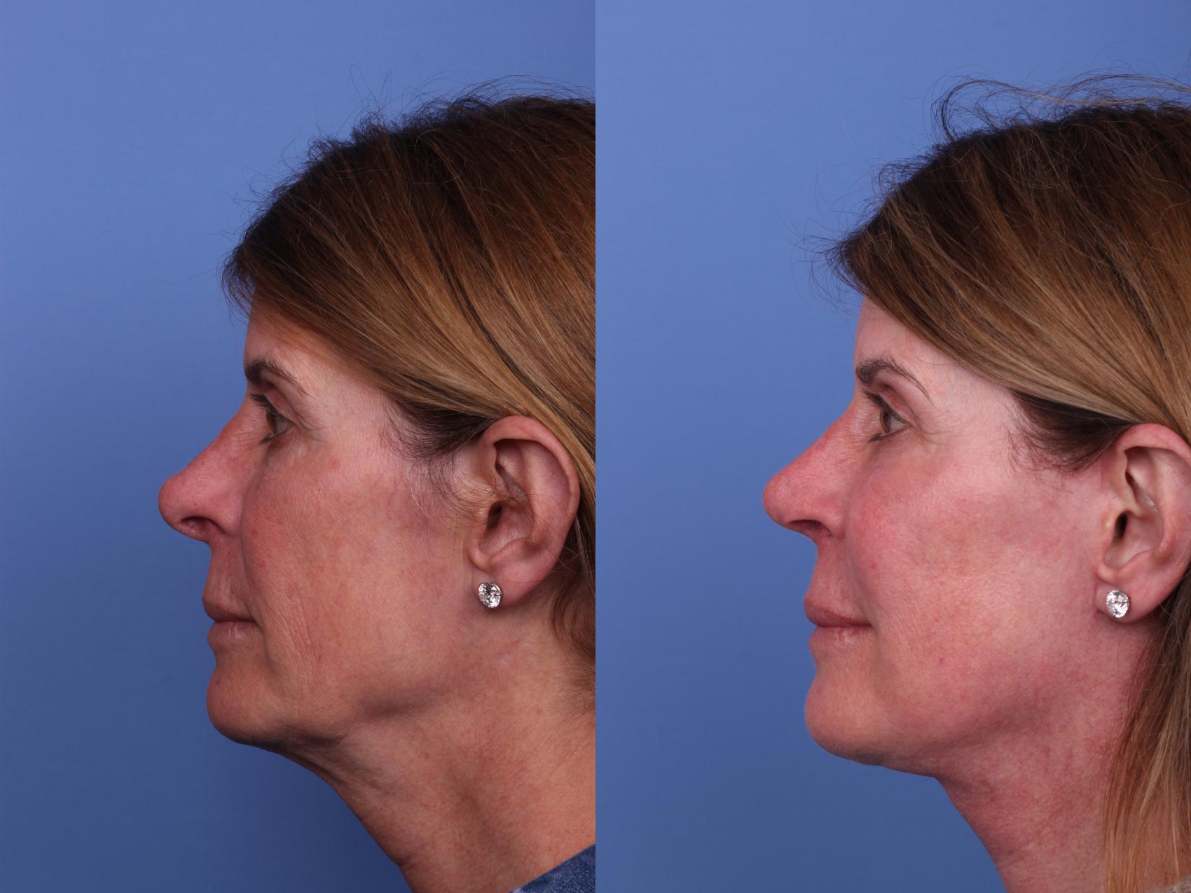 Before & After Facelift Case 537 Left Side View in Scottsdale, AZ