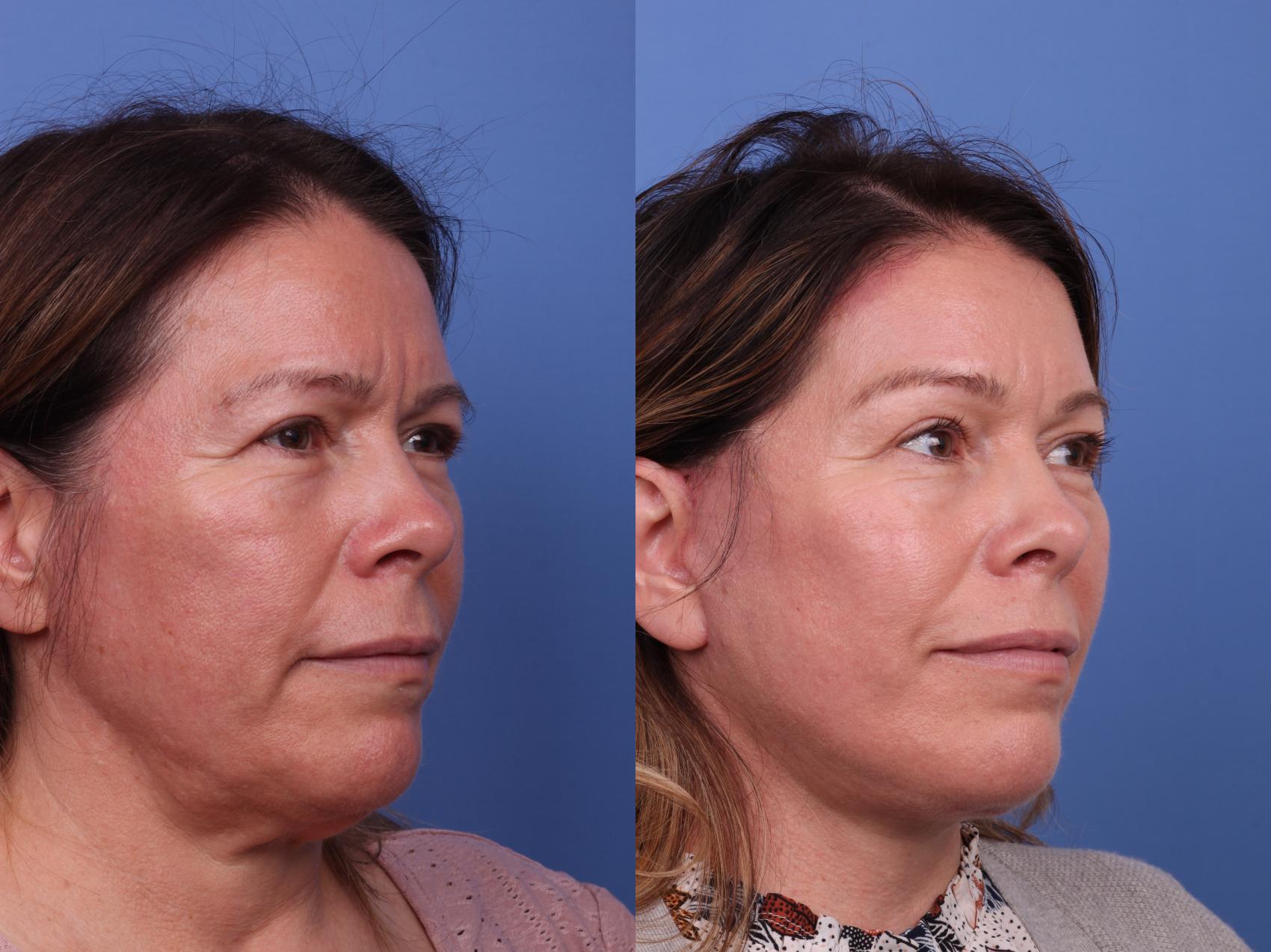 Before & After Brow Lift Case 543 Right Oblique View in Scottsdale, AZ