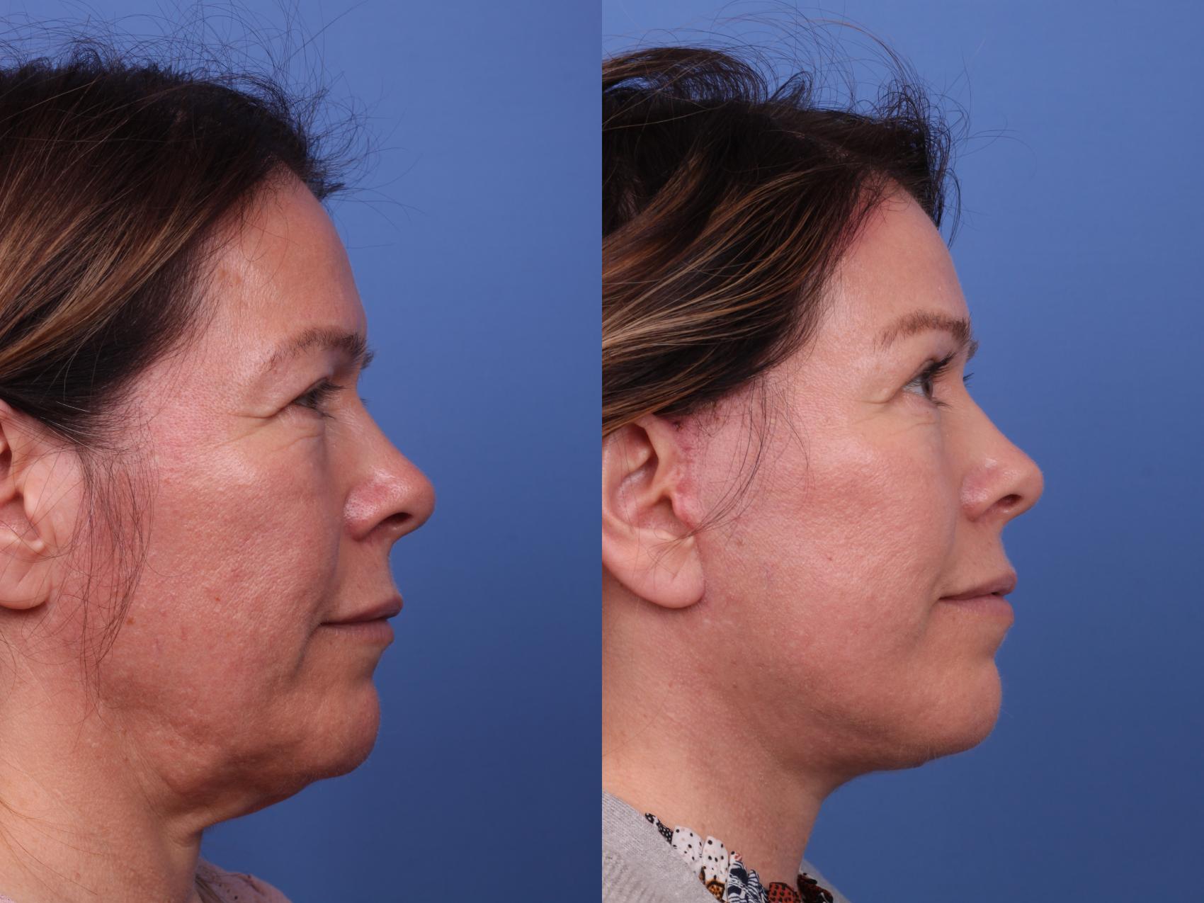 Before & After Brow Lift Case 543 Right Side View in Scottsdale, AZ