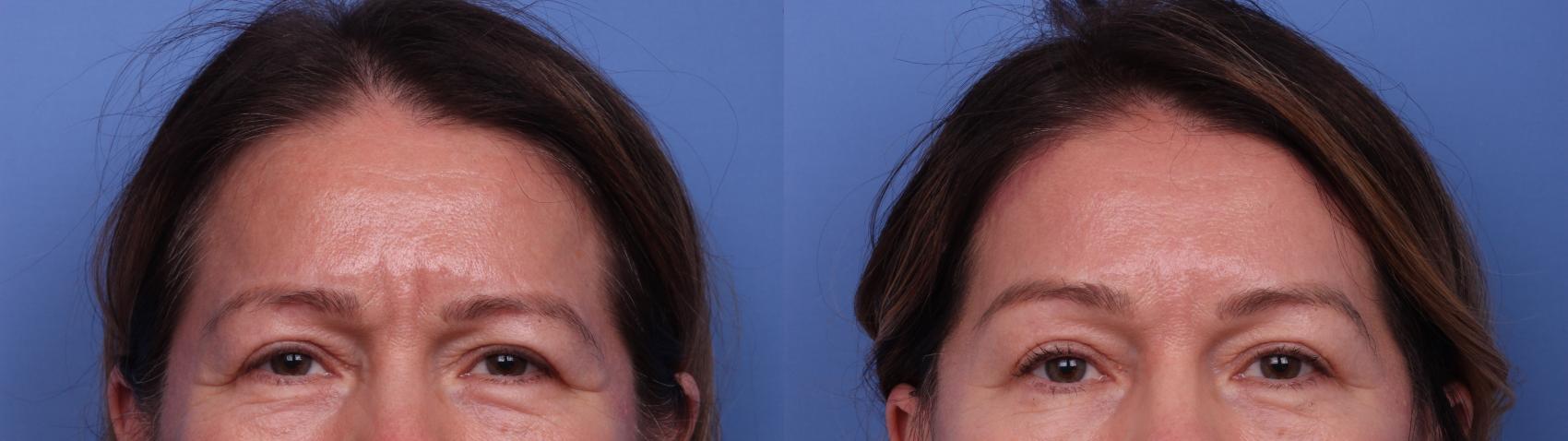 Before & After Brow Lift Case 543 Zoom Brow View in Scottsdale, AZ