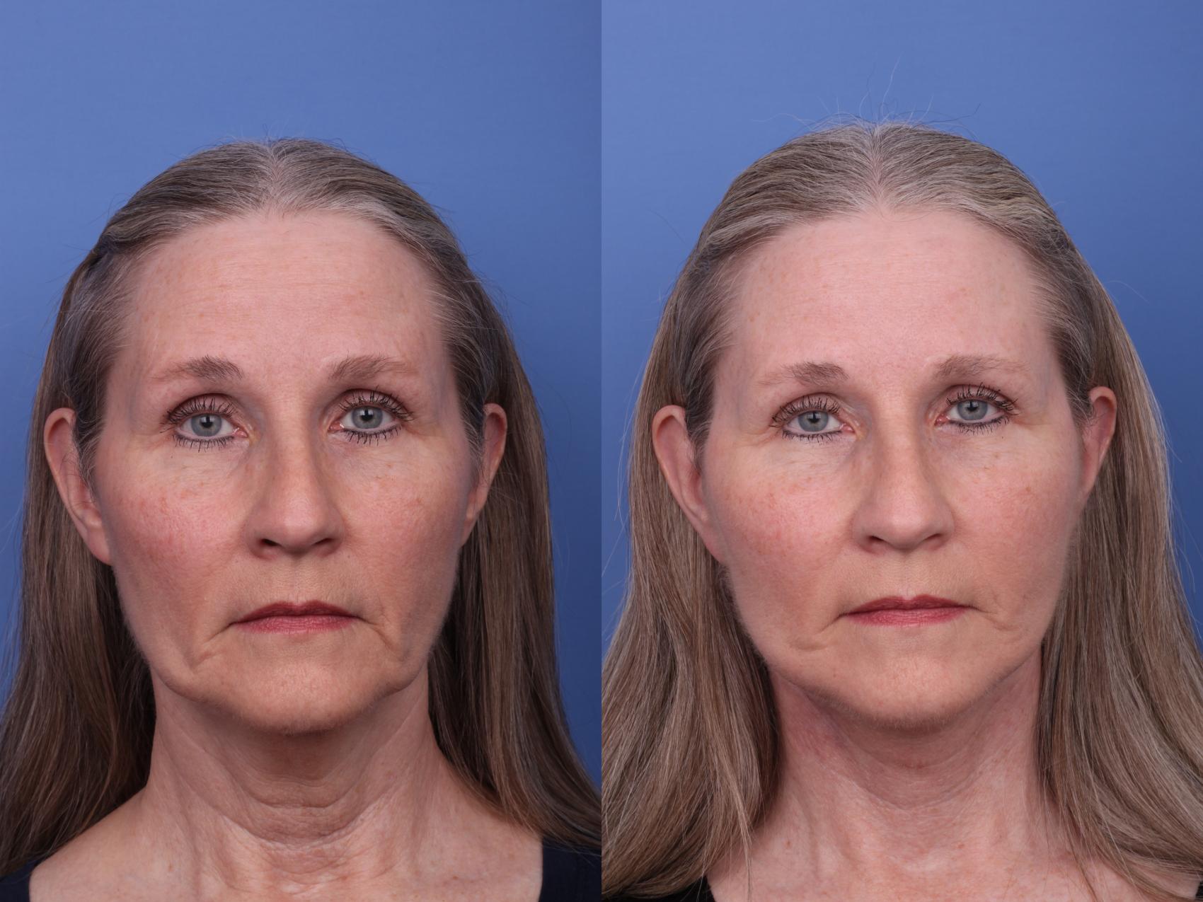 Before & After Facelift Case 560 Front View in Scottsdale, AZ