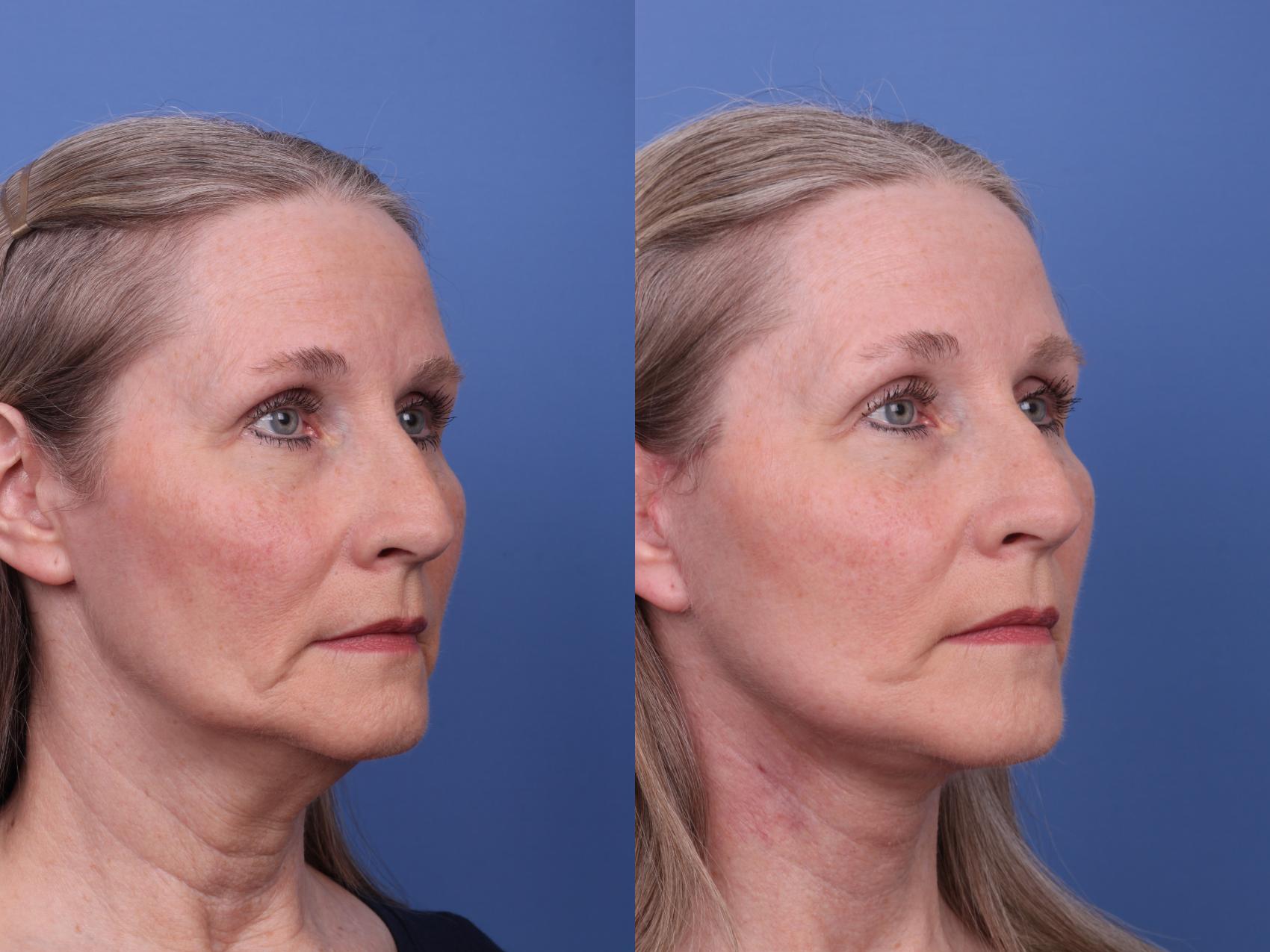 Before & After Facelift Case 560 Right Oblique View in Scottsdale, AZ