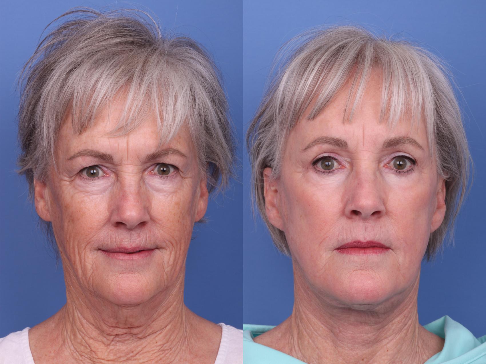 Before & After Facelift Case 563 Front View in Scottsdale, AZ