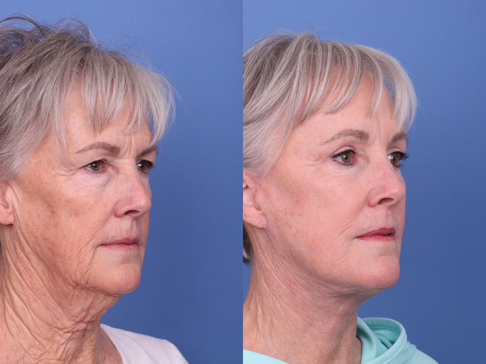 Facelift Before & After Photo | Scottsdale & Phoenix, AZ | Hobgood Facial Plastic Surgery: Todd Hobgood, MD