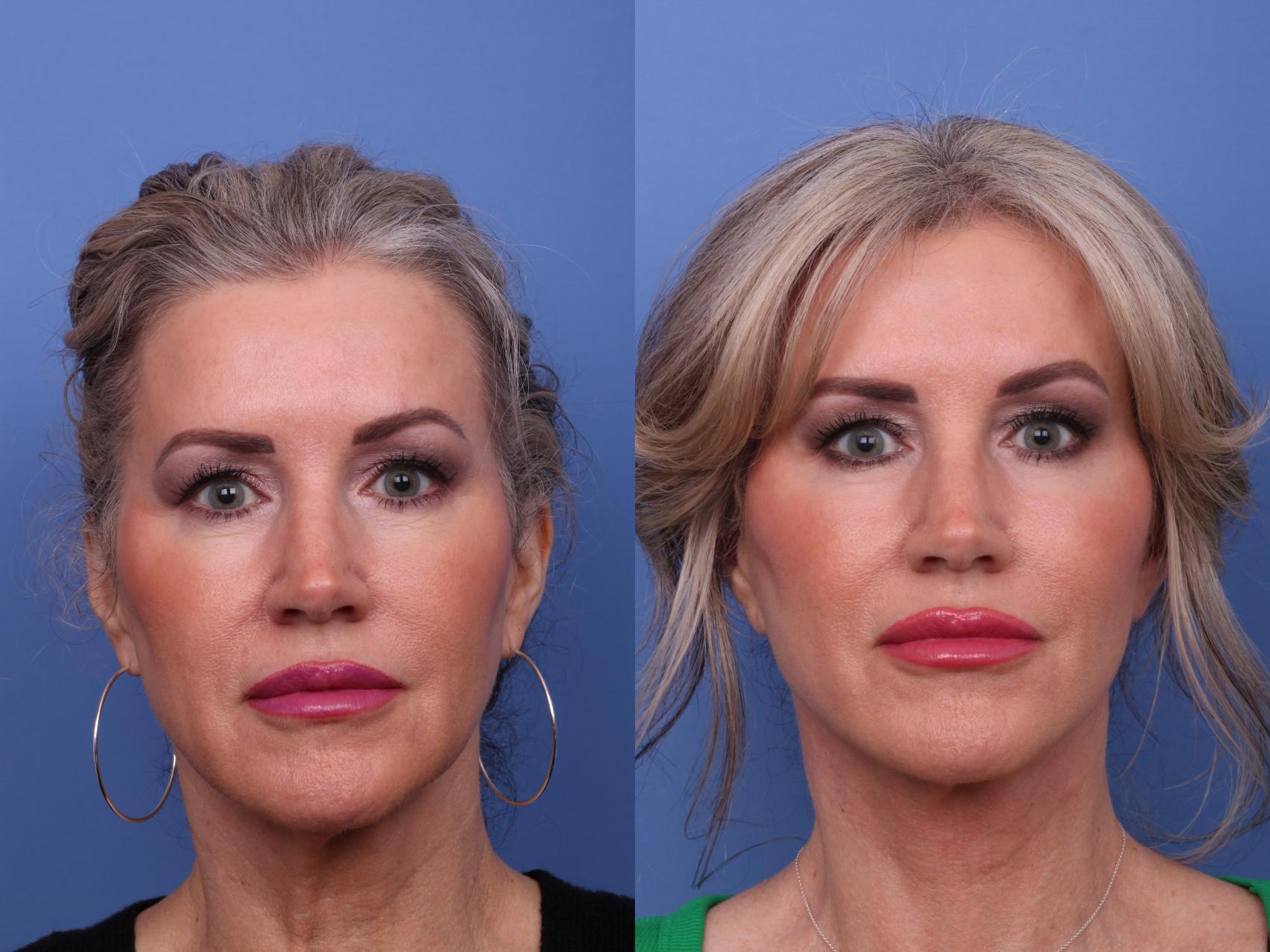 Before & After Facelift Case 564 Front View in Scottsdale, AZ