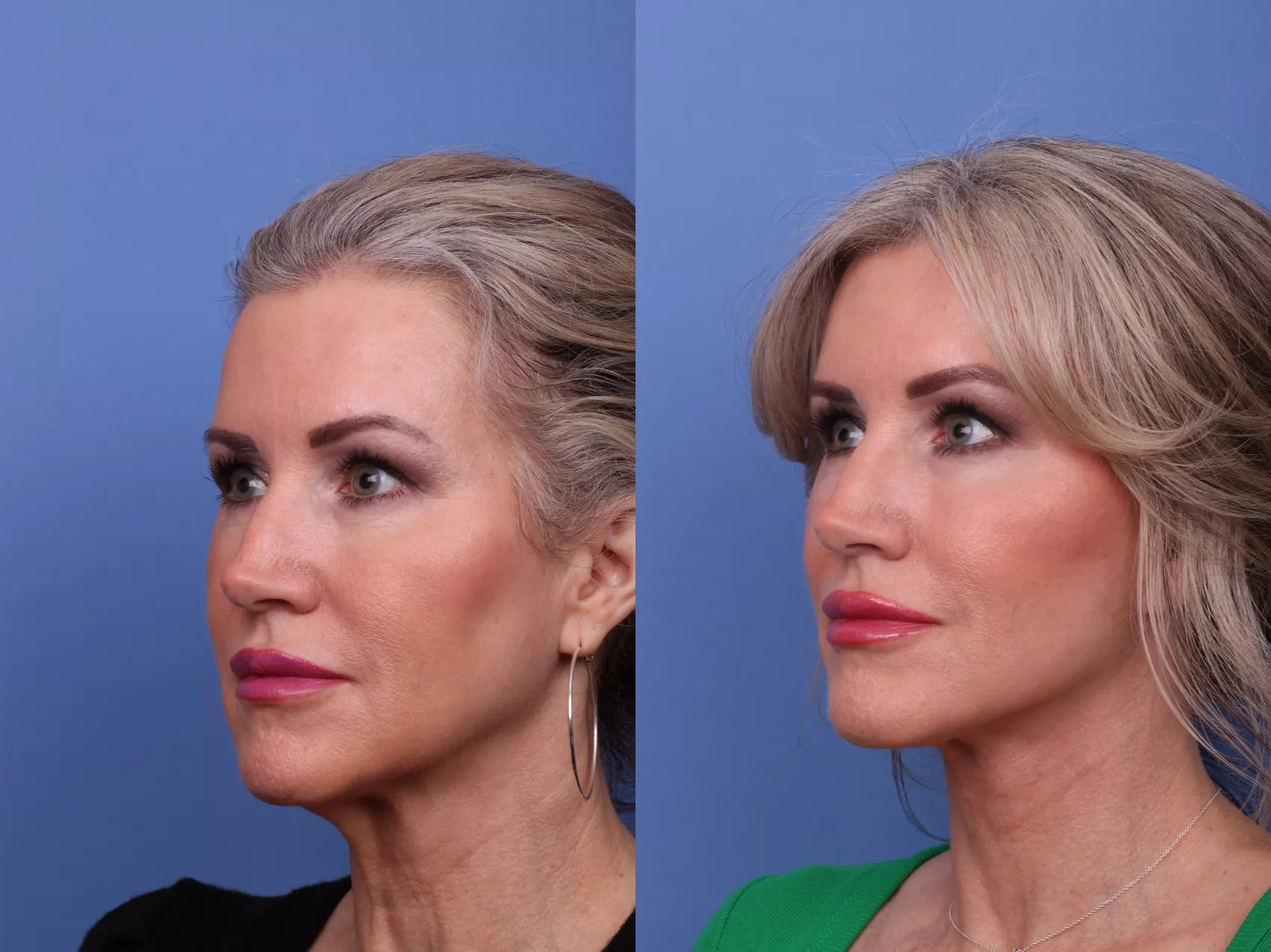facelift-564-left-oblique-
