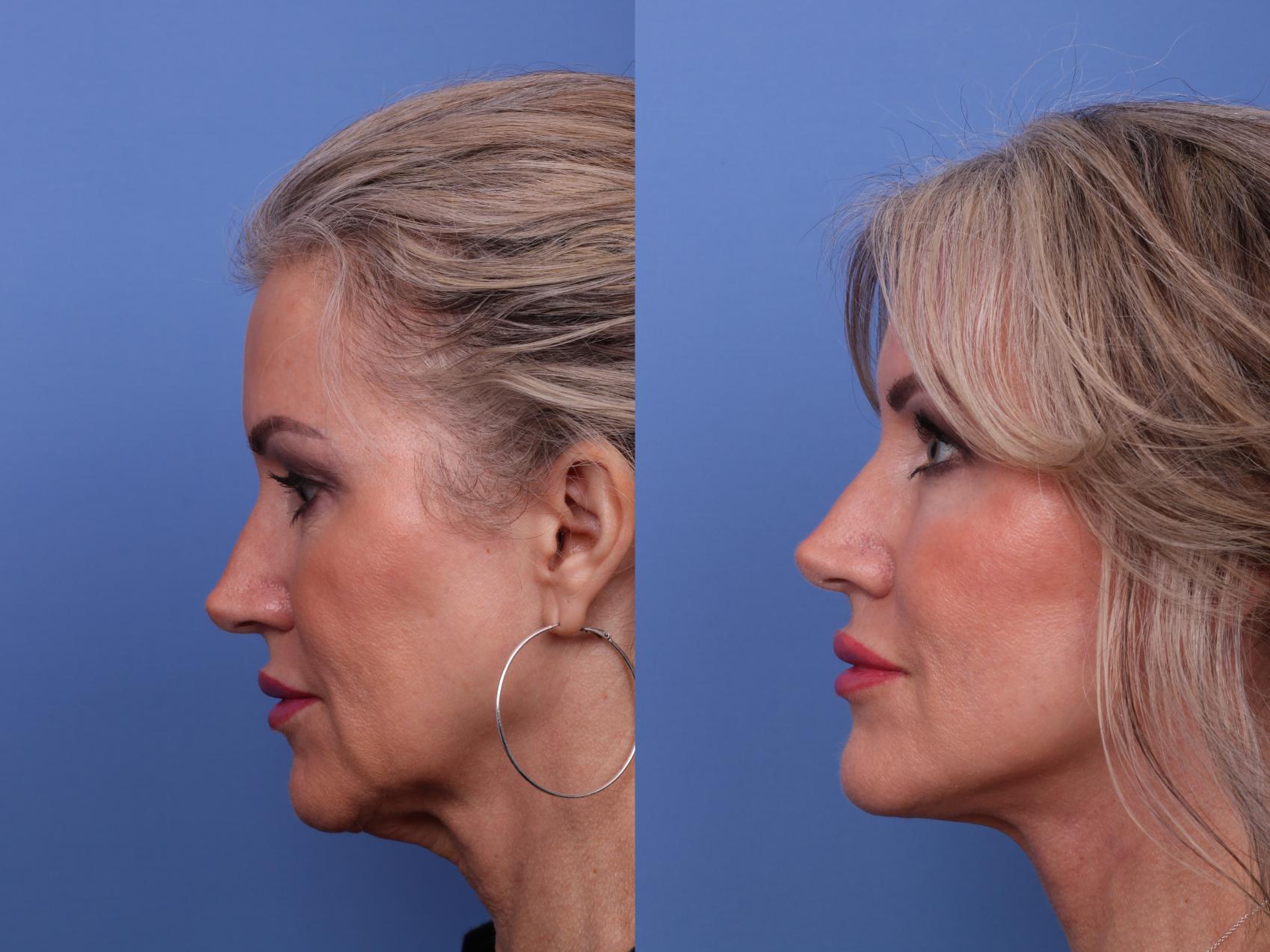 Before & After Facelift Case 564 Left Side View in Scottsdale, AZ