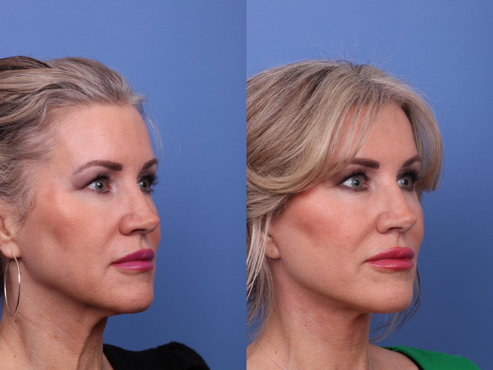 Before & After Facelift Case 564 Right Oblique View in Scottsdale, AZ