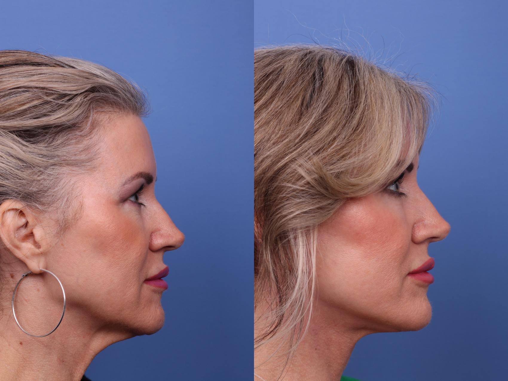 Before & After Facelift Case 564 Right Side View in Scottsdale, AZ