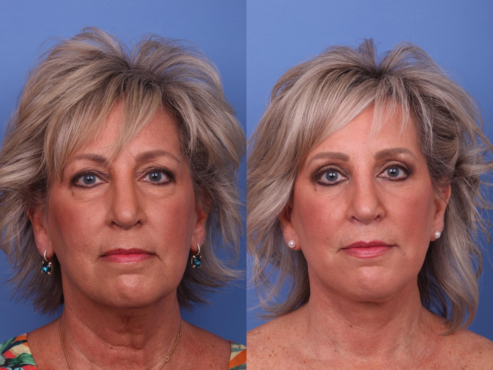 Facelift Before & After Photo | Scottsdale & Phoenix, AZ | Hobgood Facial Plastic Surgery: Todd Hobgood, MD