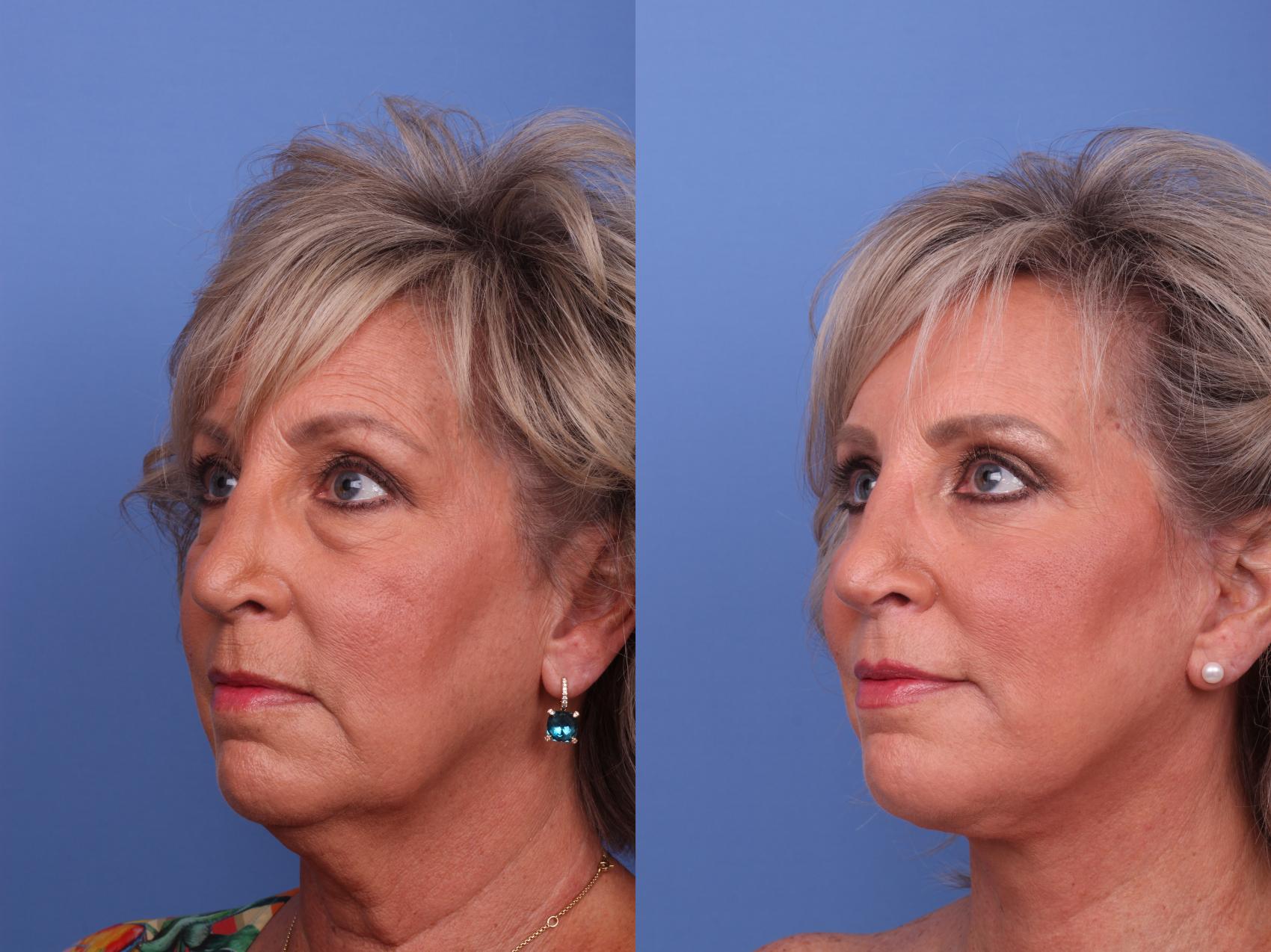 Before & After Facelift Case 571 Left Oblique View in Scottsdale, AZ