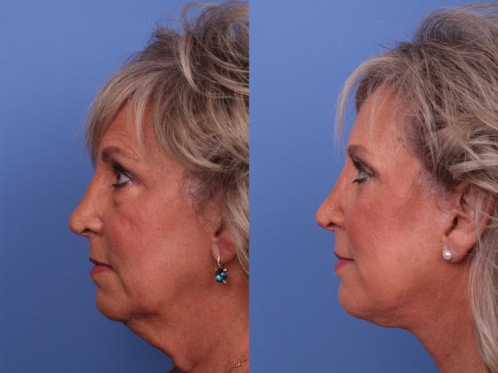 Blepharoplasty Before & After Photo | Scottsdale & Phoenix, AZ | Hobgood Facial Plastic Surgery: Todd Hobgood, MD