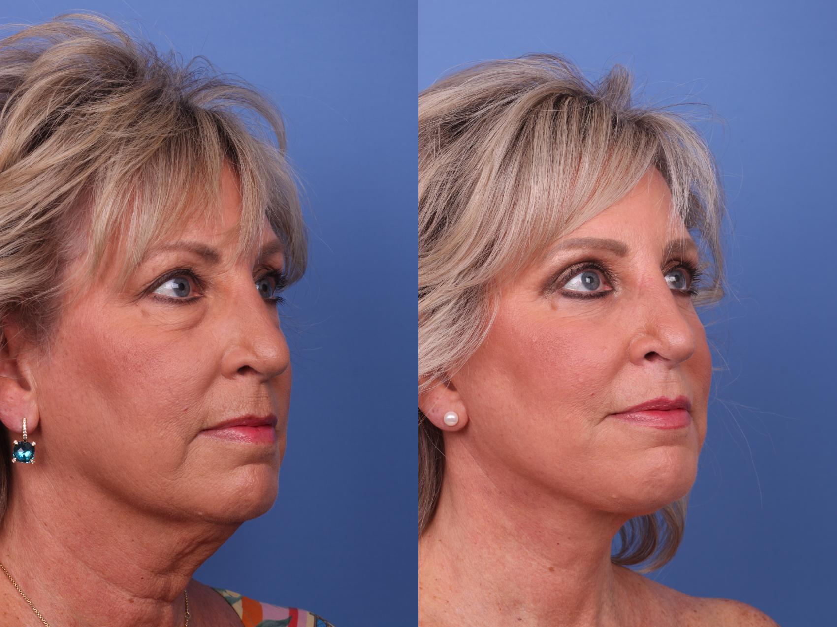 Before & After Facelift Case 571 Right Oblique View in Scottsdale, AZ