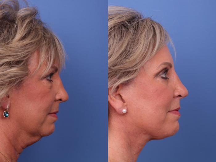 Facelift Before & After Photo | Scottsdale & Phoenix, AZ | Hobgood Facial Plastic Surgery: Todd Hobgood, MD