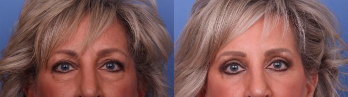 Facelift Before & After Photo | Scottsdale & Phoenix, AZ | Hobgood Facial Plastic Surgery: Todd Hobgood, MD