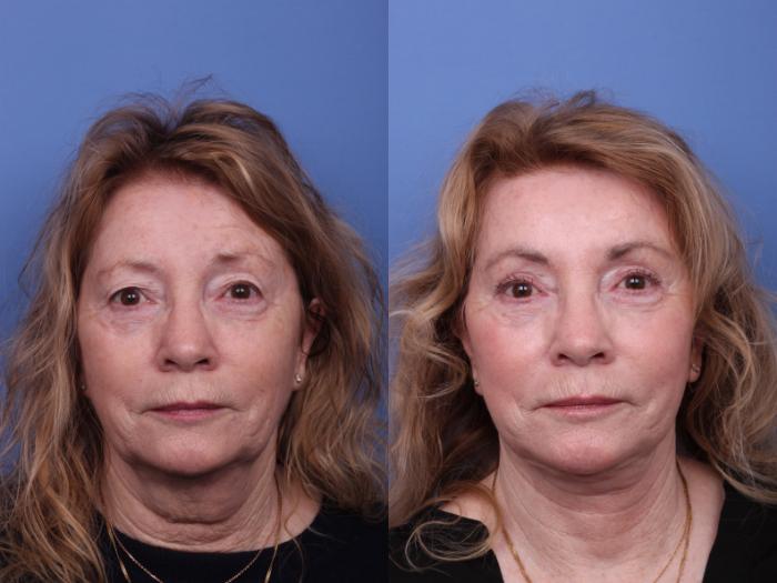 Facelift Before & After Photo | Scottsdale & Phoenix, AZ | Hobgood Facial Plastic Surgery: Todd Hobgood, MD