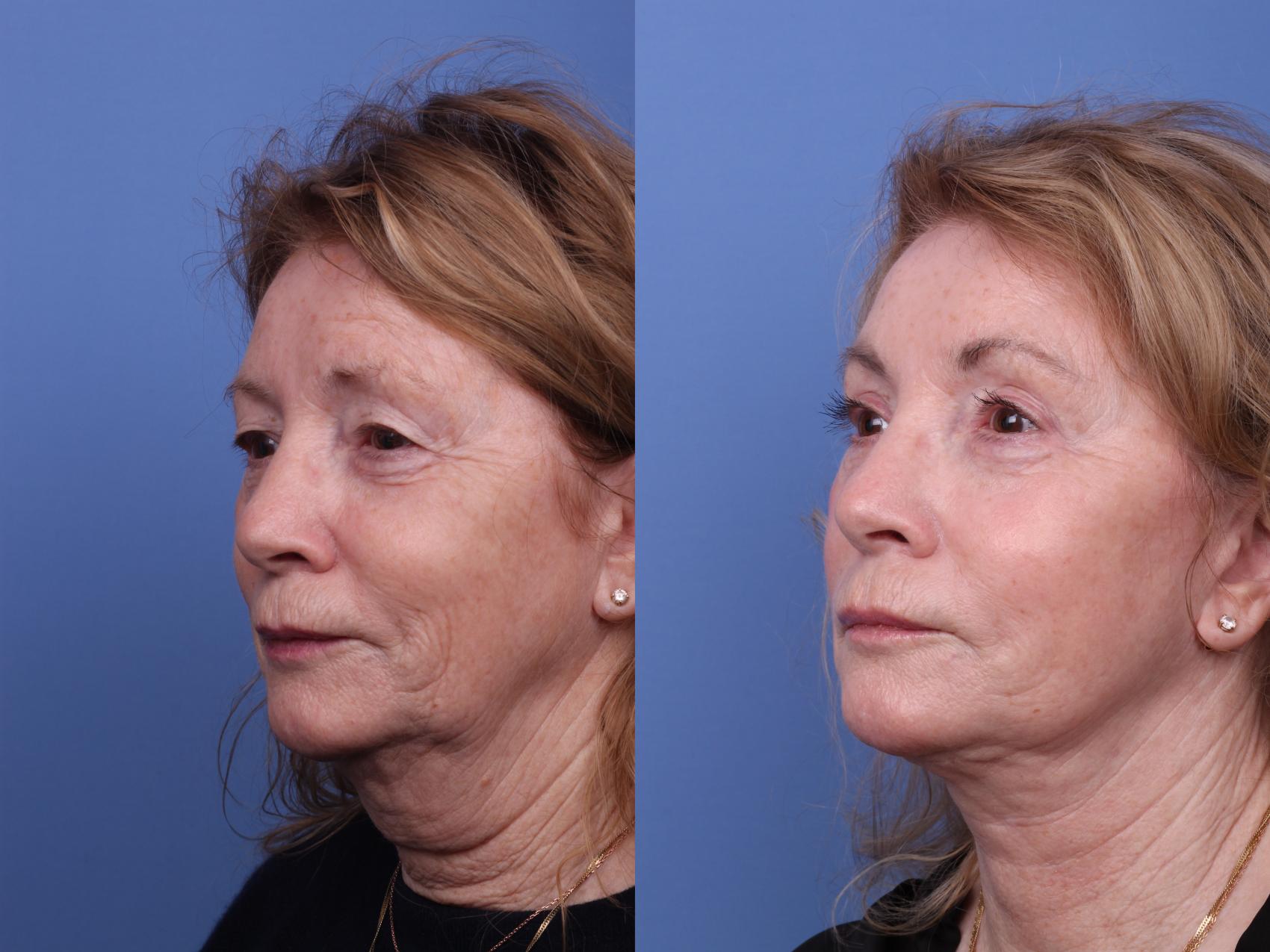Before & After Facelift Case 572 Left Oblique View in Scottsdale, AZ