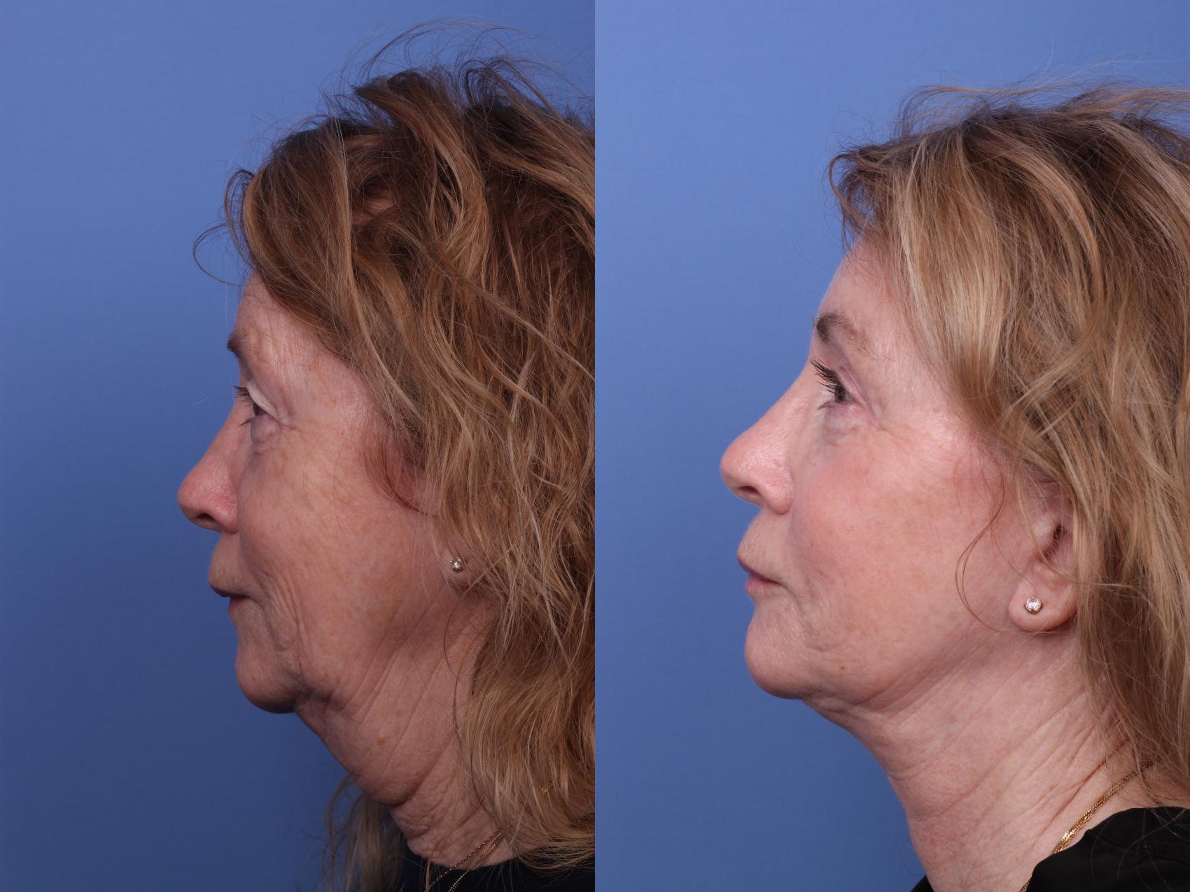 Before & After Facelift Case 572 Left Side View in Scottsdale, AZ