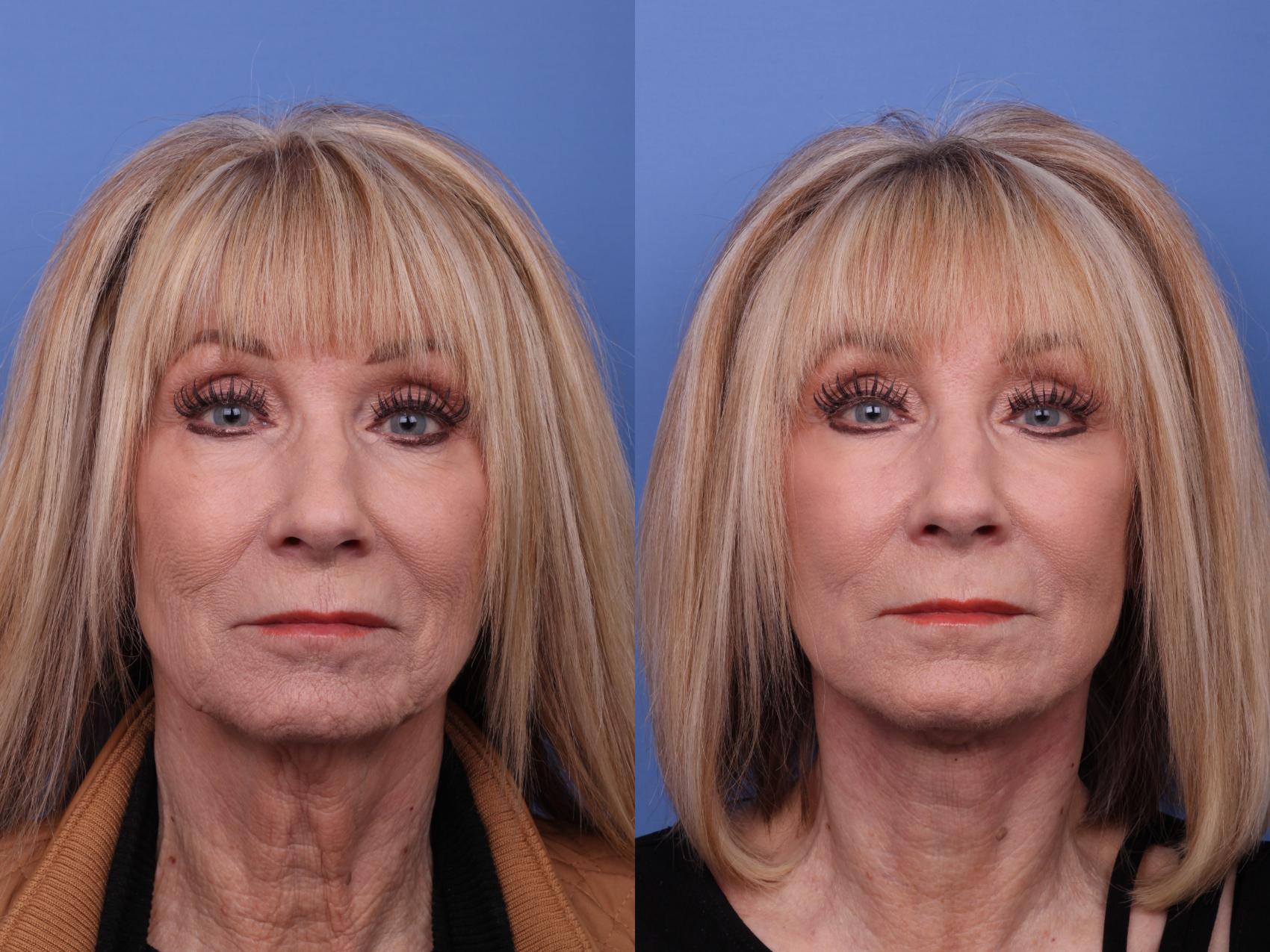 Facelift Before & After Photo | Scottsdale & Phoenix, AZ | Hobgood Facial Plastic Surgery: Todd Hobgood, MD