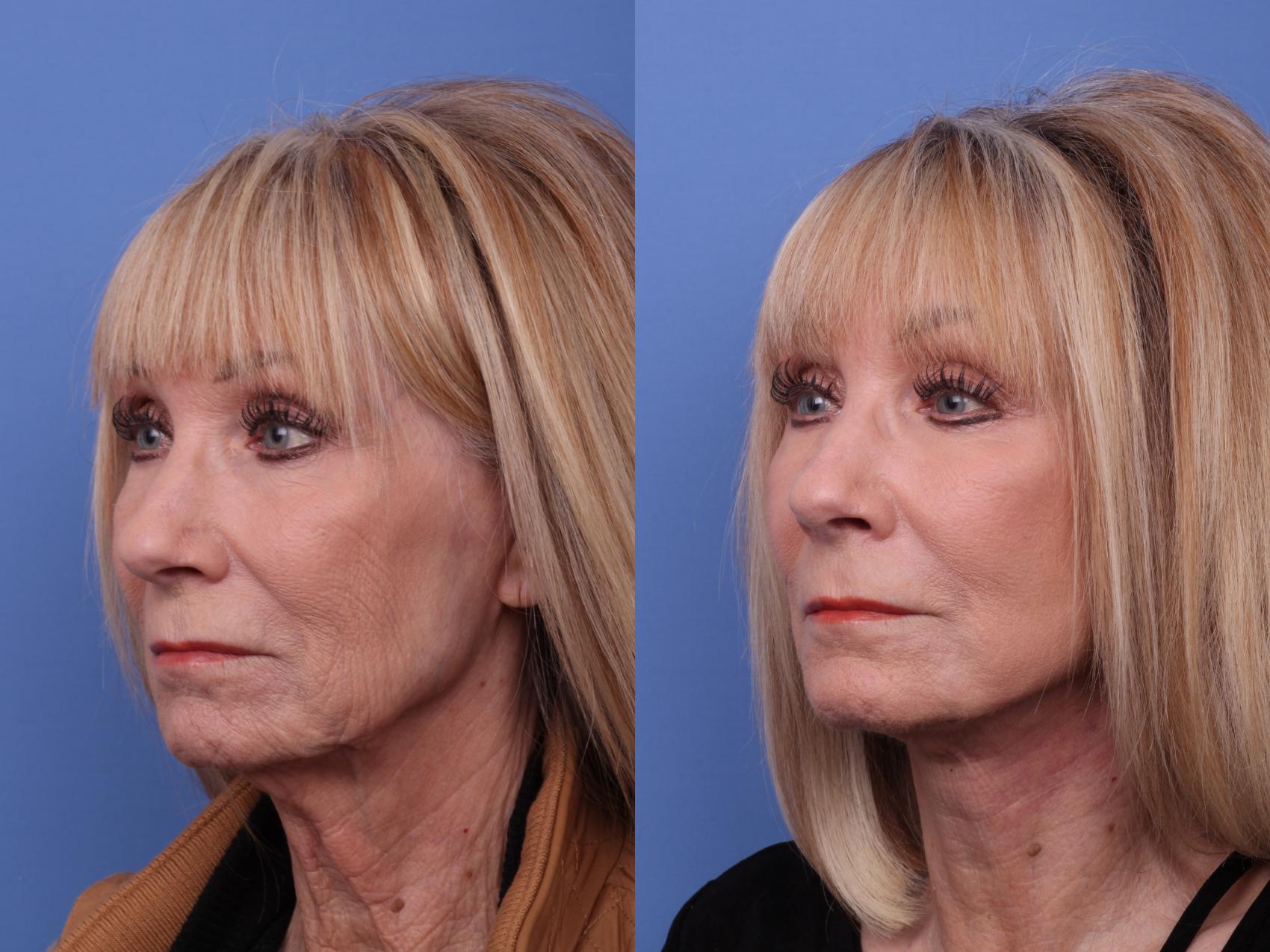 Before & After Facelift Case 574 Left Oblique View in Scottsdale, AZ