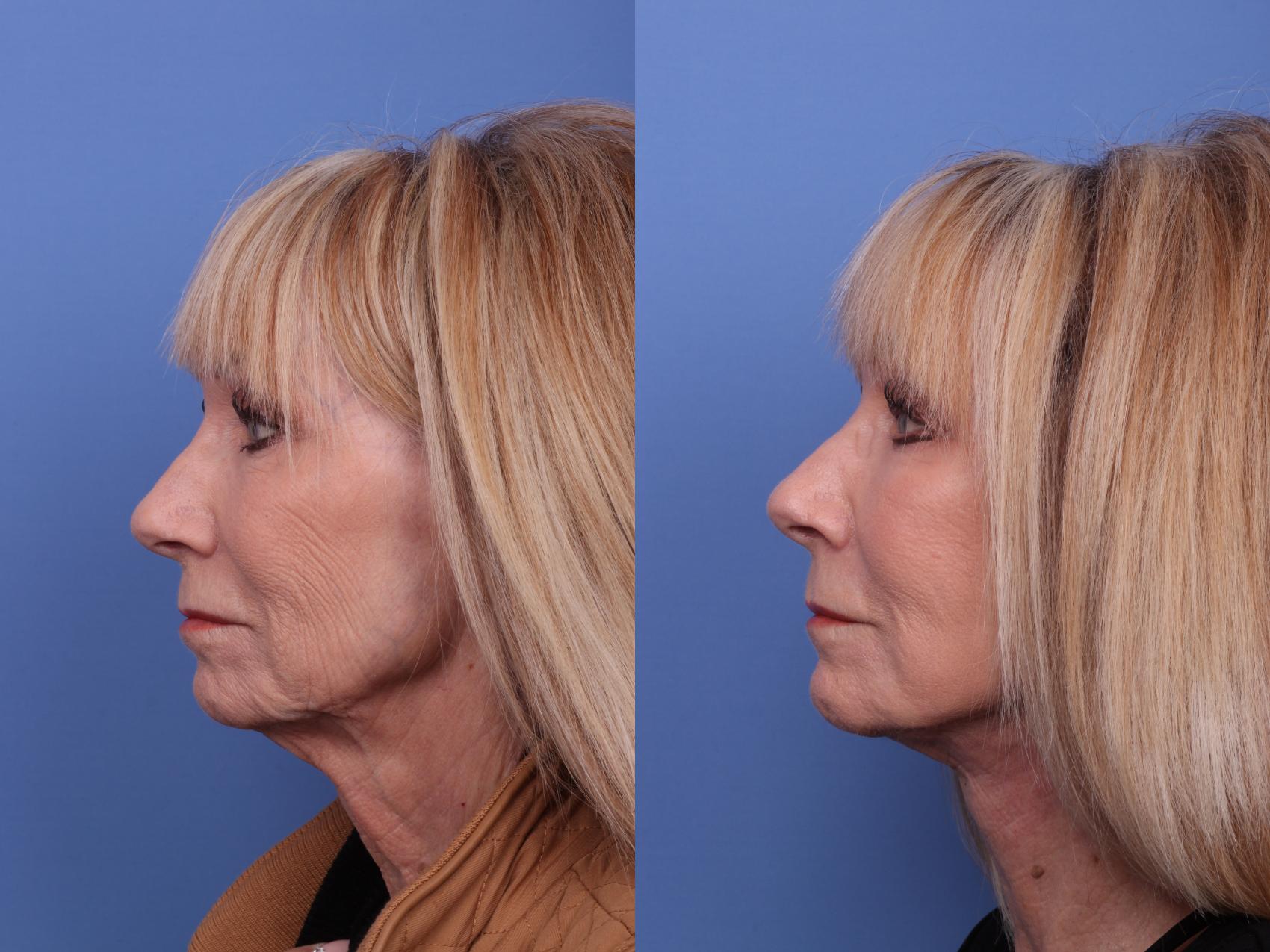 Before & After Facelift Case 574 Left Side View in Scottsdale, AZ