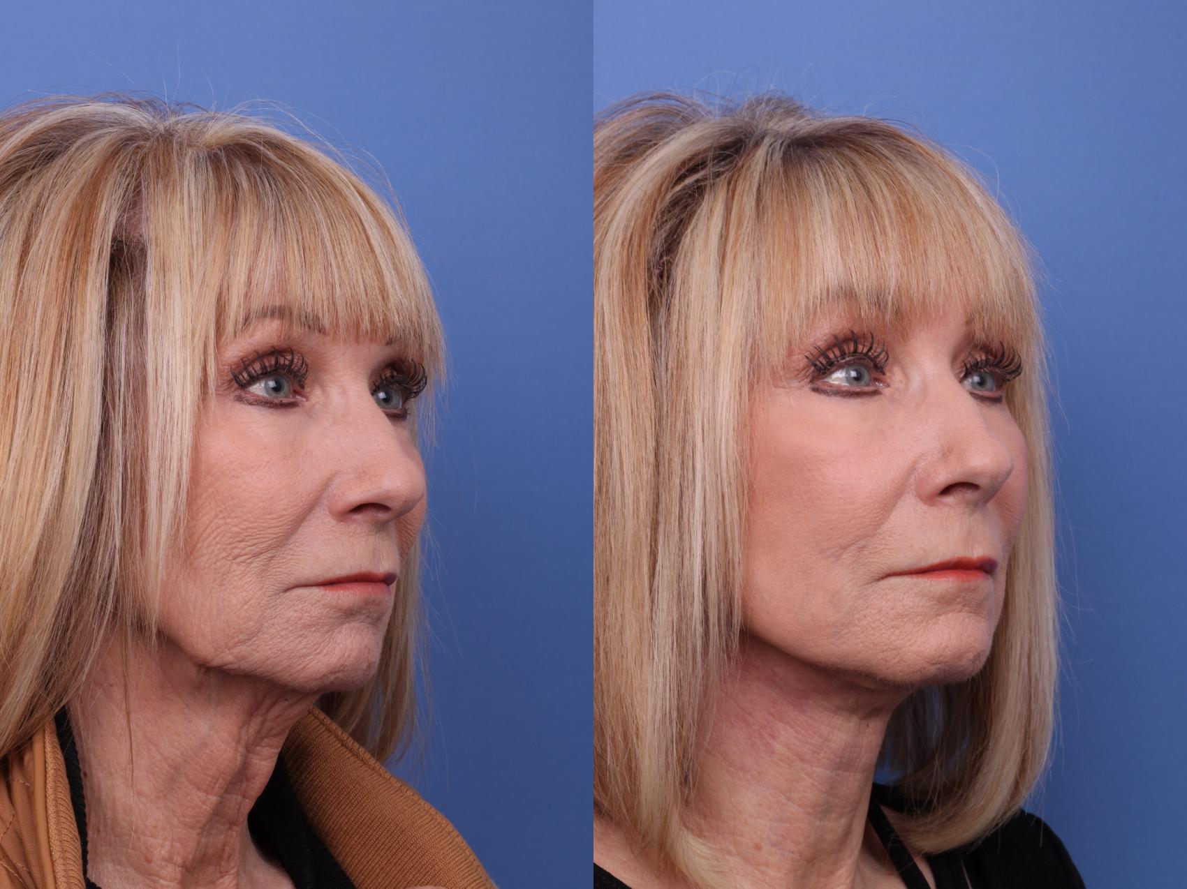 Before & After Facelift Case 574 Right Oblique View in Scottsdale, AZ