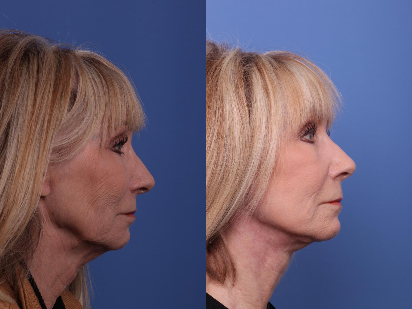 Before & After Facelift Case 574 Right Side View in Scottsdale, AZ