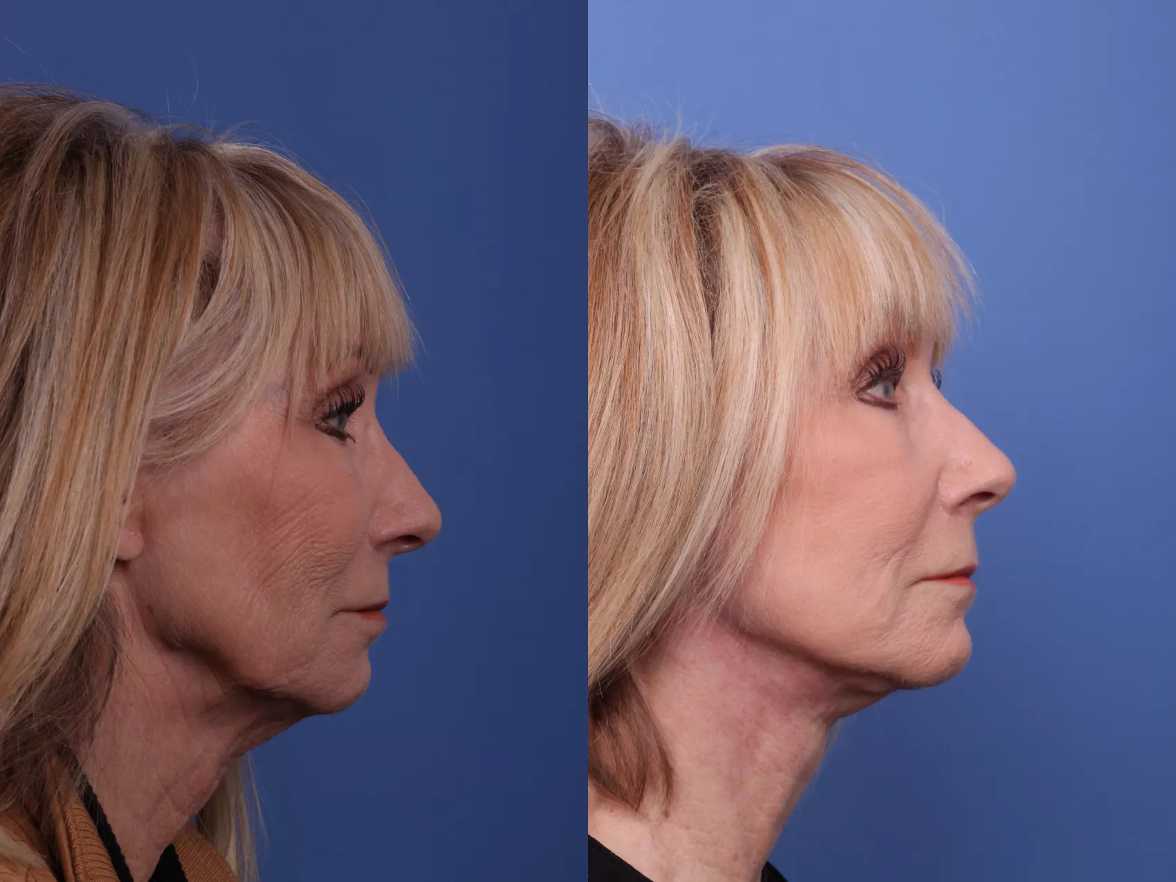 Facelift Before and After Pictures Case 574 | Scottsdale, AZ