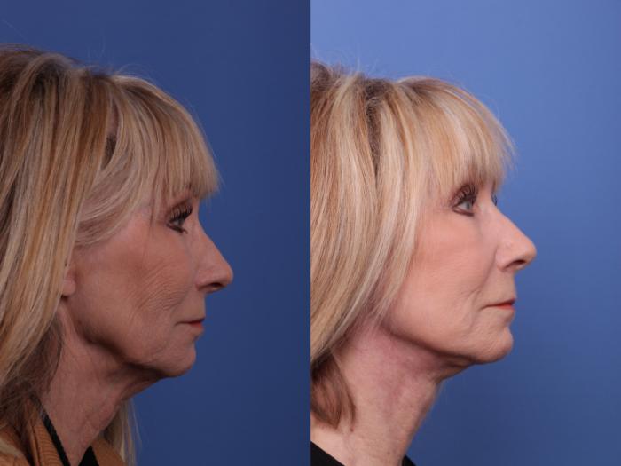 Facelift Before & After Photo | Scottsdale & Phoenix, AZ | Hobgood Facial Plastic Surgery: Todd Hobgood, MD