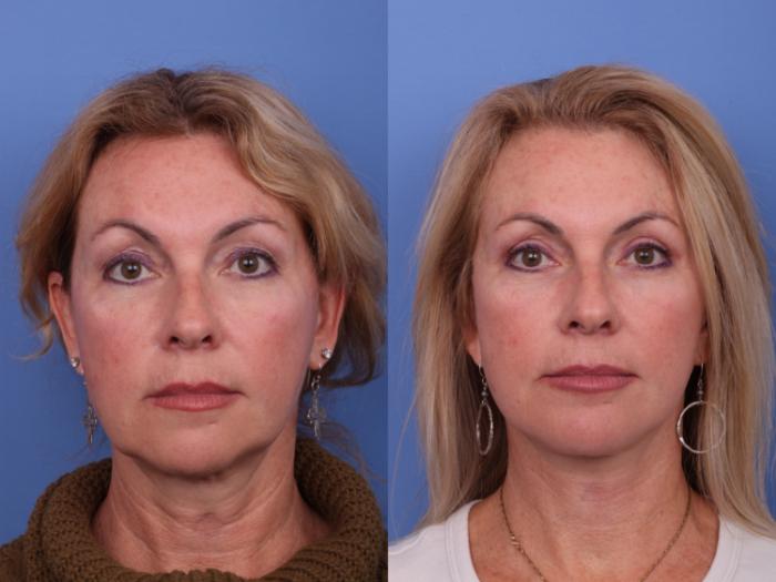 Facelift Before & After Photo | Scottsdale & Phoenix, AZ | Hobgood Facial Plastic Surgery: Todd Hobgood, MD