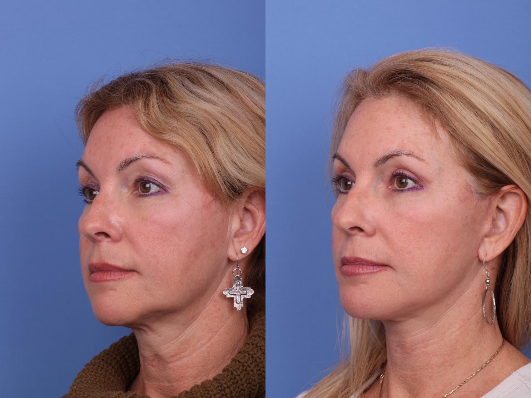 Before & After Facelift Case 579 Left Oblique View in Scottsdale, AZ