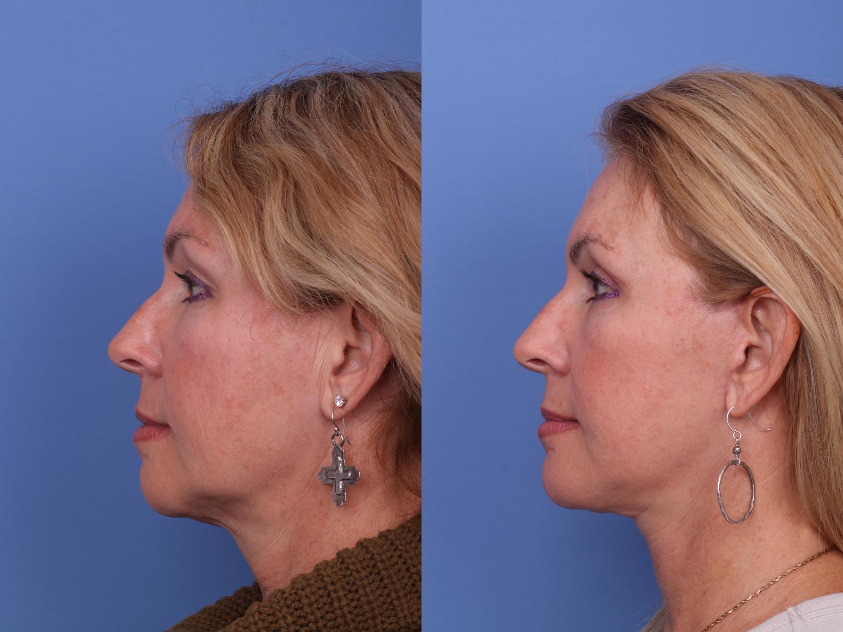 Before & After Facelift Case 579 Left Side View in Scottsdale, AZ
