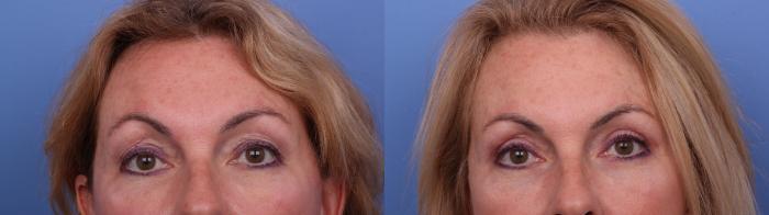 Facelift Before & After Photo | Scottsdale & Phoenix, AZ | Hobgood Facial Plastic Surgery: Todd Hobgood, MD