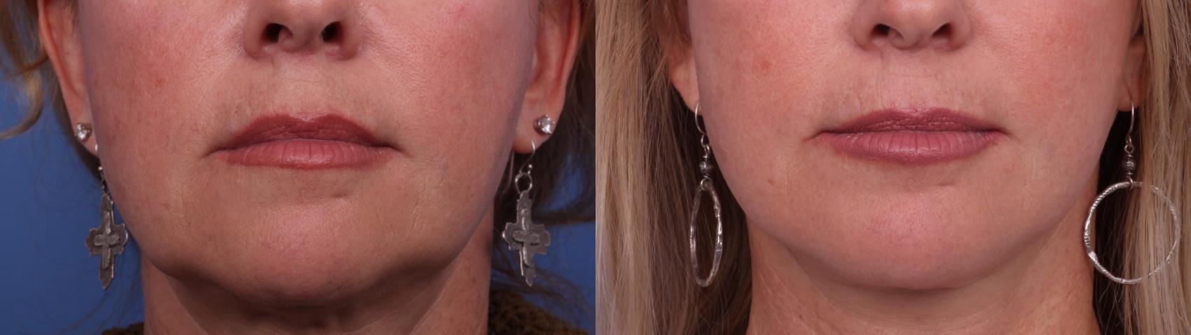 Before & After Facelift Case 579 Zoom Chin Aug View in Scottsdale, AZ
