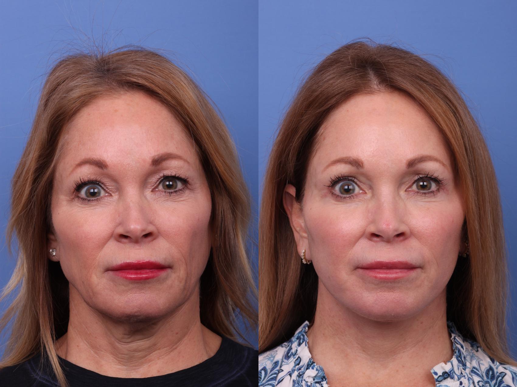 Facelift Before & After Photo | Scottsdale & Phoenix, AZ | Hobgood Facial Plastic Surgery: Todd Hobgood, MD