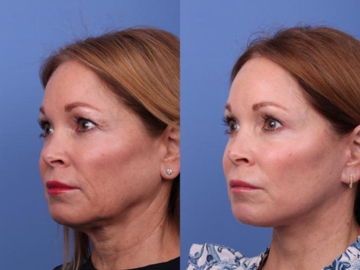 Facelift Before & After Photo | Scottsdale & Phoenix, AZ | Hobgood Facial Plastic Surgery: Todd Hobgood, MD