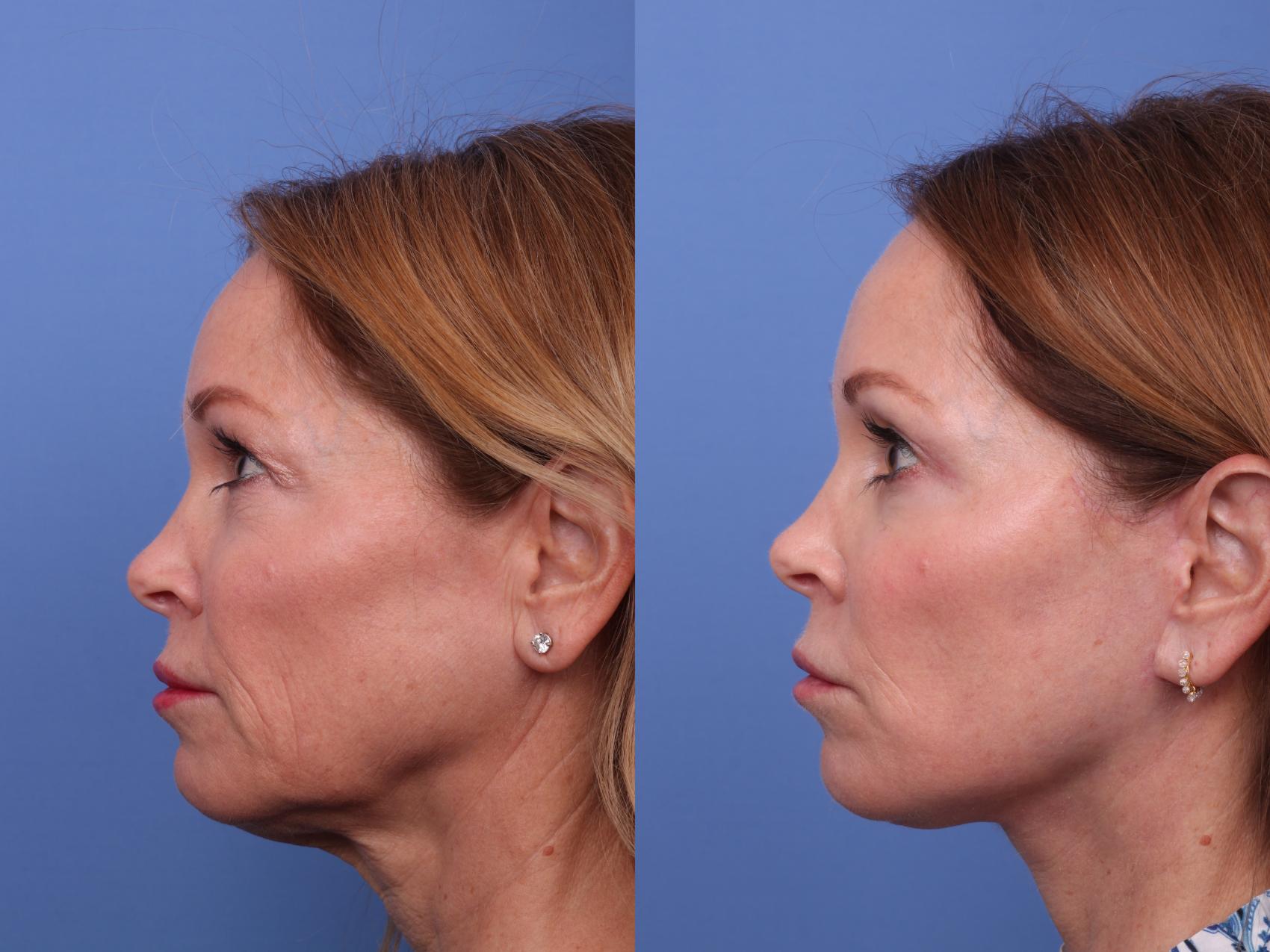 Before & After Facelift Case 591 Left Side View in Scottsdale, AZ