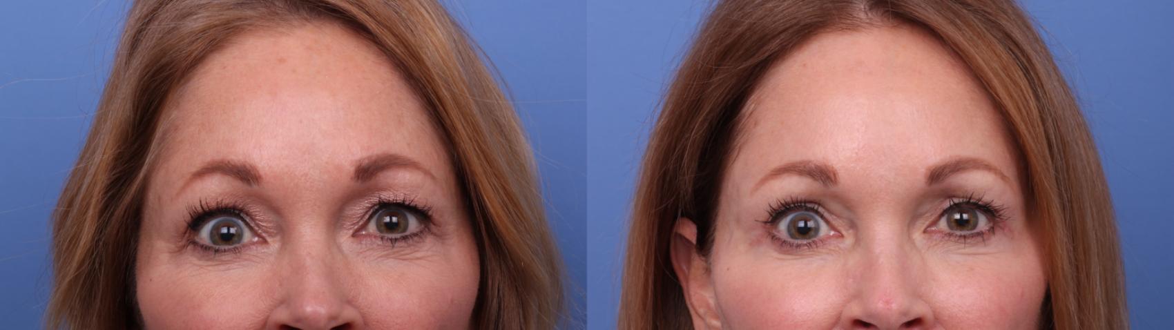 Before & After Facelift Case 591 Zoom Bleph View in Scottsdale, AZ