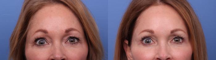 Facelift Before & After Photo | Scottsdale & Phoenix, AZ | Hobgood Facial Plastic Surgery: Todd Hobgood, MD