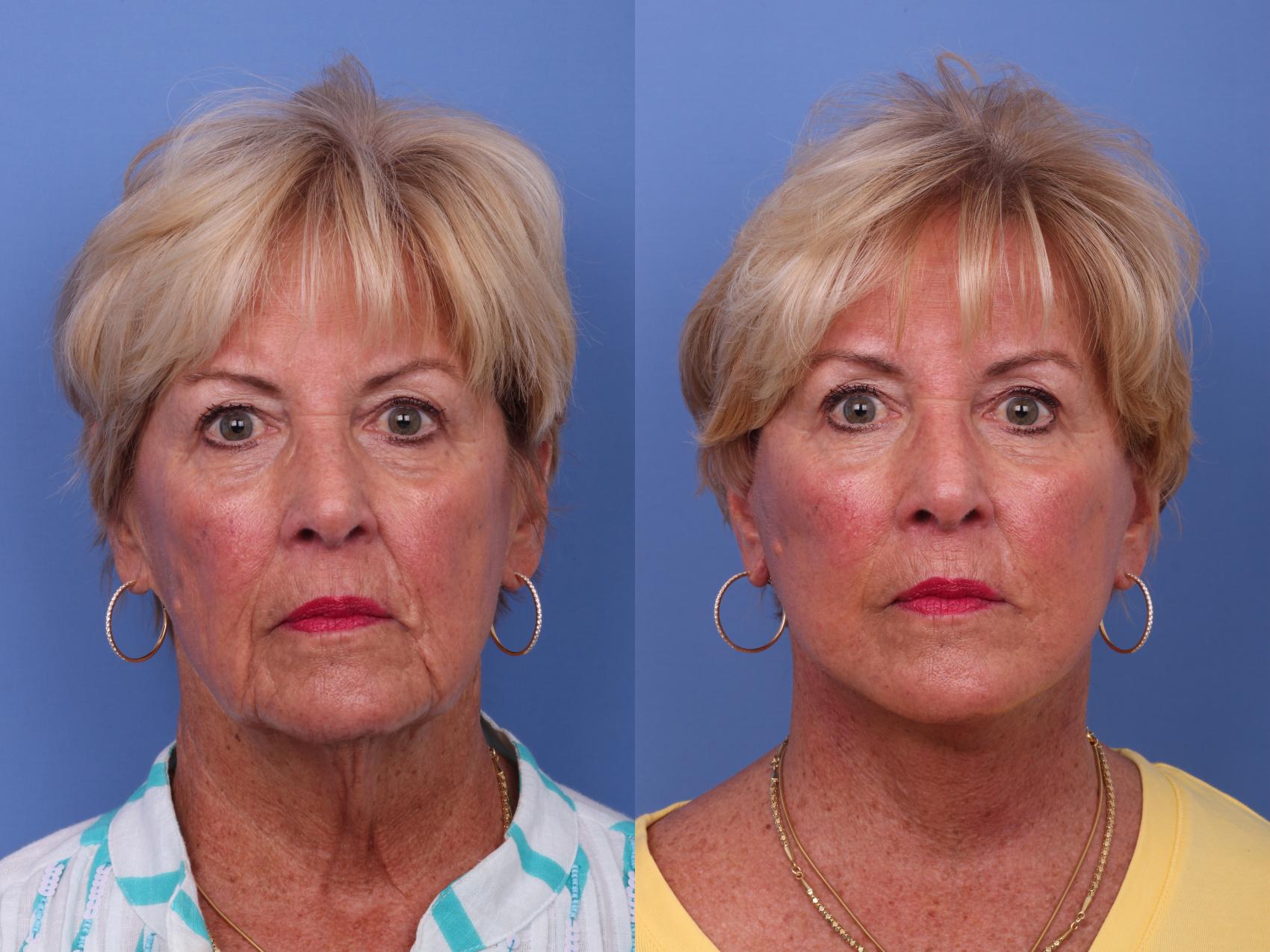 Facelift Before & After Photo | Scottsdale & Phoenix, AZ | Hobgood Facial Plastic Surgery: Todd Hobgood, MD