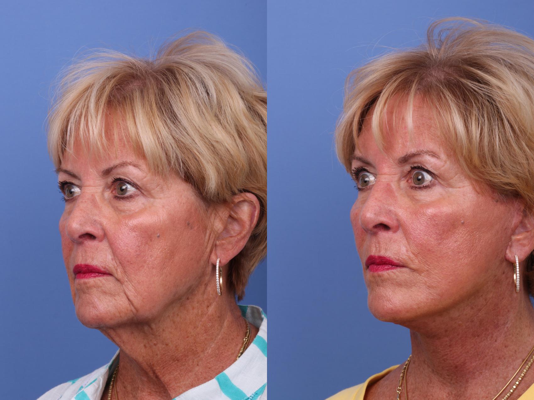 Before & After Facelift Case 594 Left Oblique View in Scottsdale, AZ
