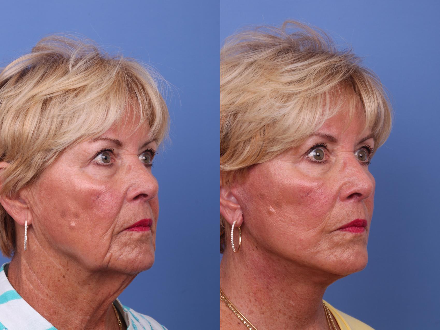 Before & After Facelift Case 594 Right Oblique View in Scottsdale, AZ