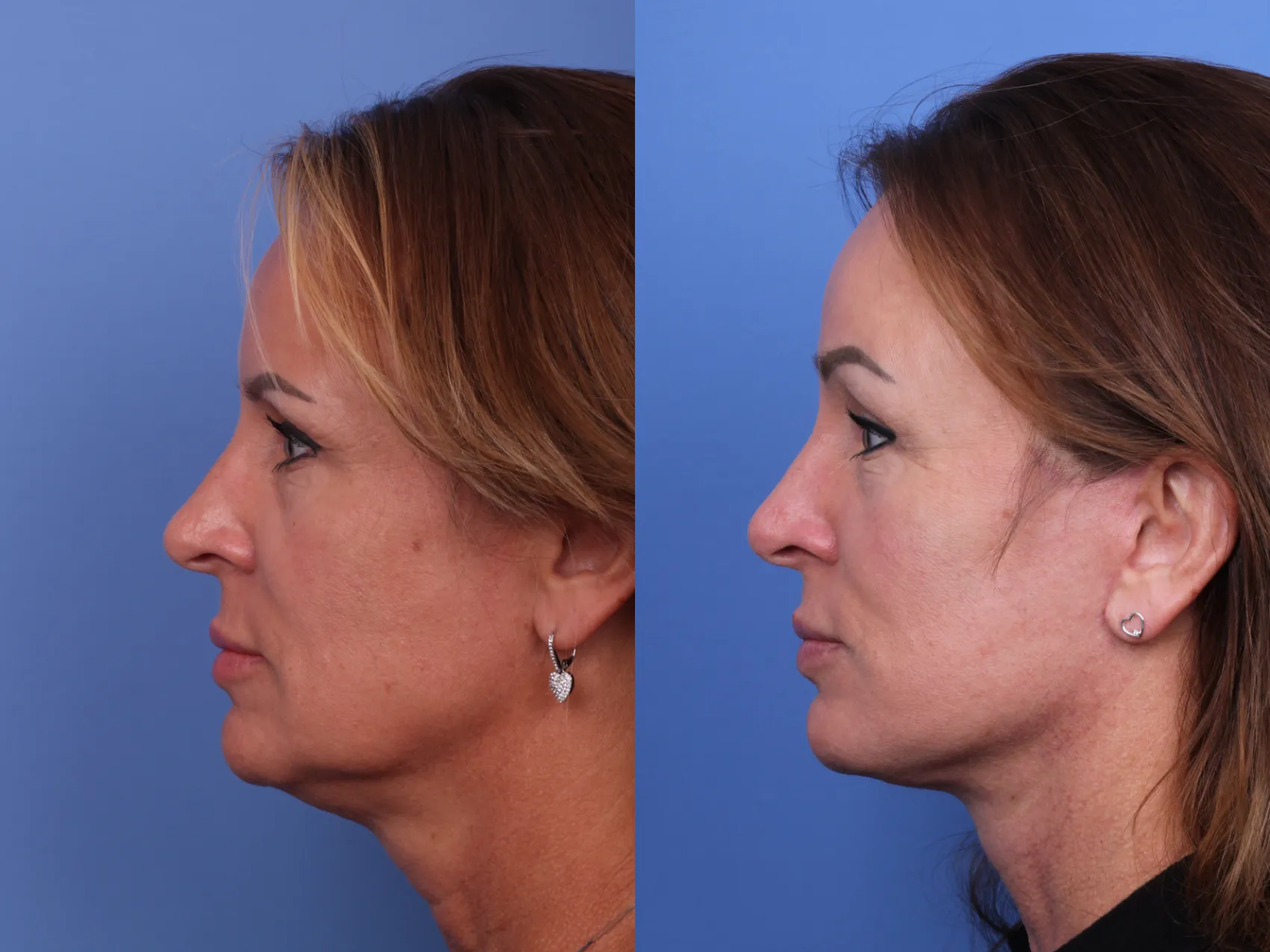 Facelift Before and After Pictures Case 600 | Scottsdale, AZ
