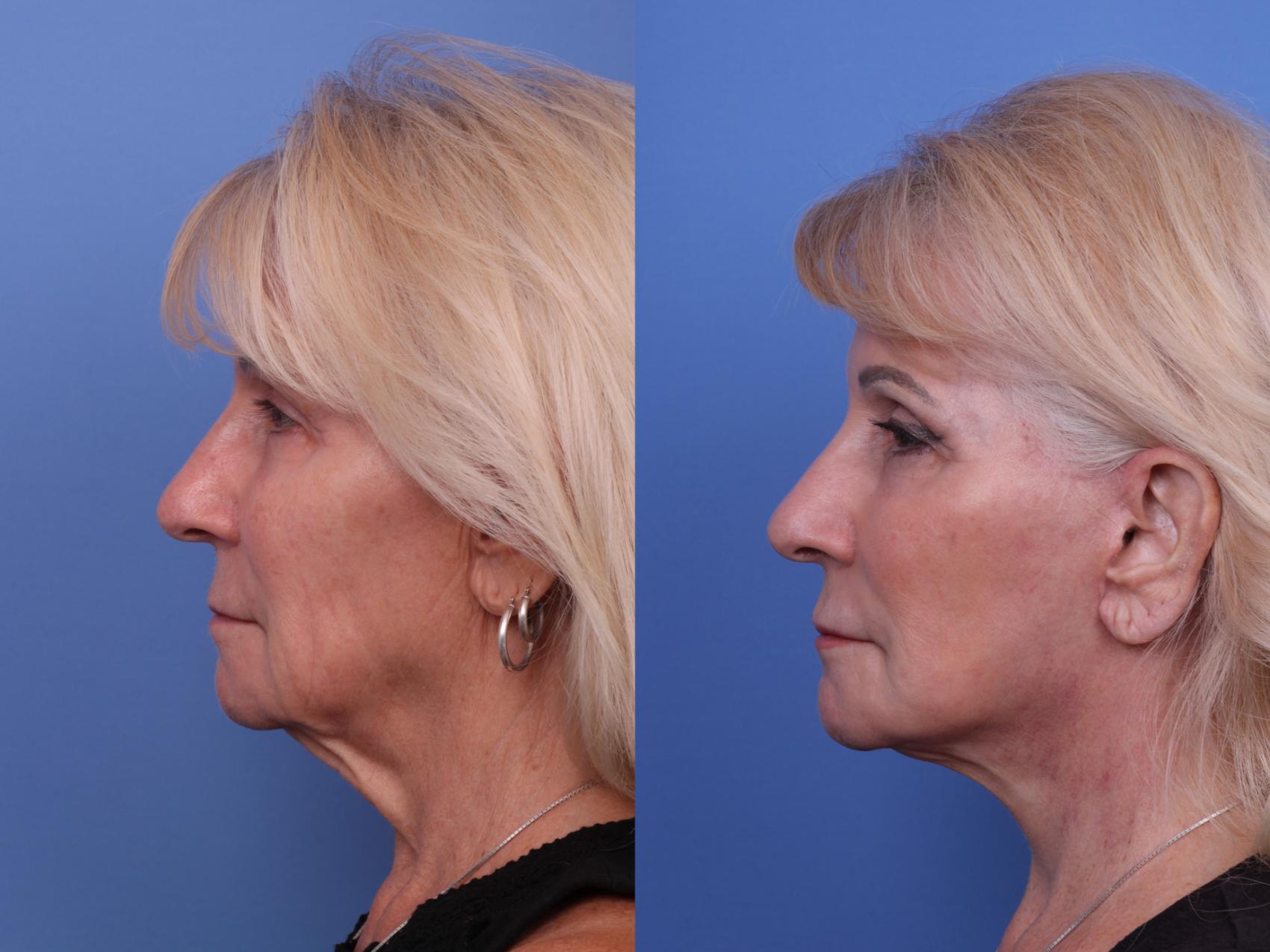 Before & After Facelift Case 603 Left Side View in Scottsdale, AZ